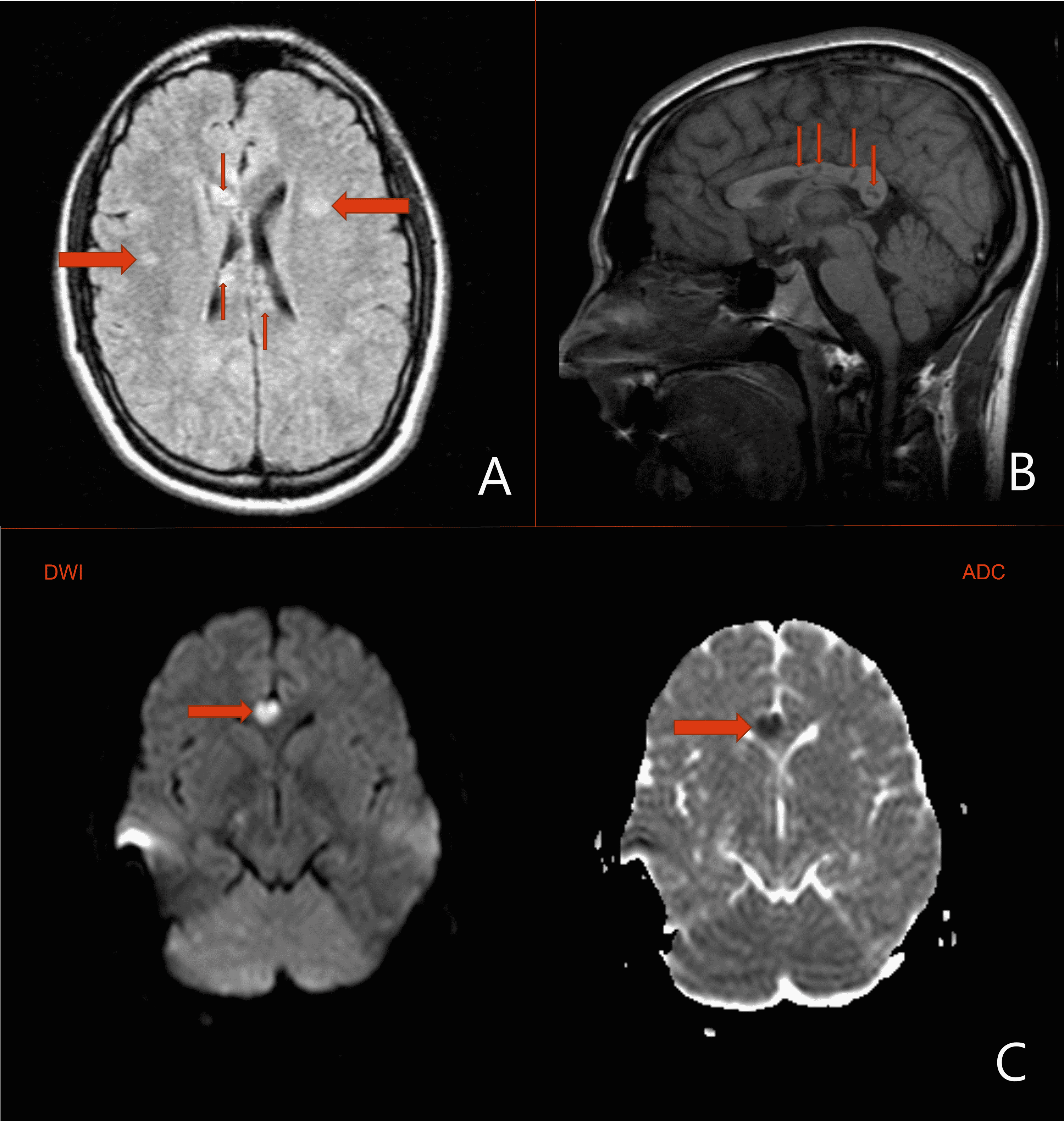 Cureus A Rare Case Of Susacs Syndrome Masquerading As Progressive