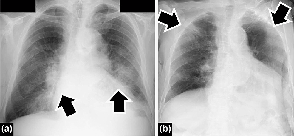 Chest-radiography-images-of-the-patient-in-the-second-case