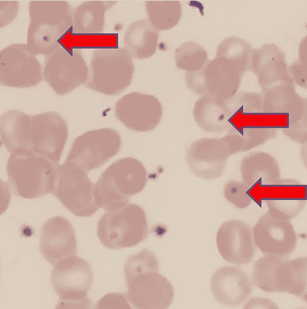 Microscopic-peripheral-blood-smear-demonstrating-Howell-Jolly-body.