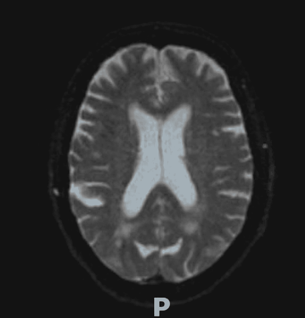--MRI-with-contrast-showing-previously-seen-white-matter-changes-with-PRES-appear-largely-resolved
