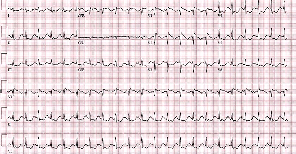 Cureus | A Case of Brugada Pattern Associated with Adrenal Insufficiency