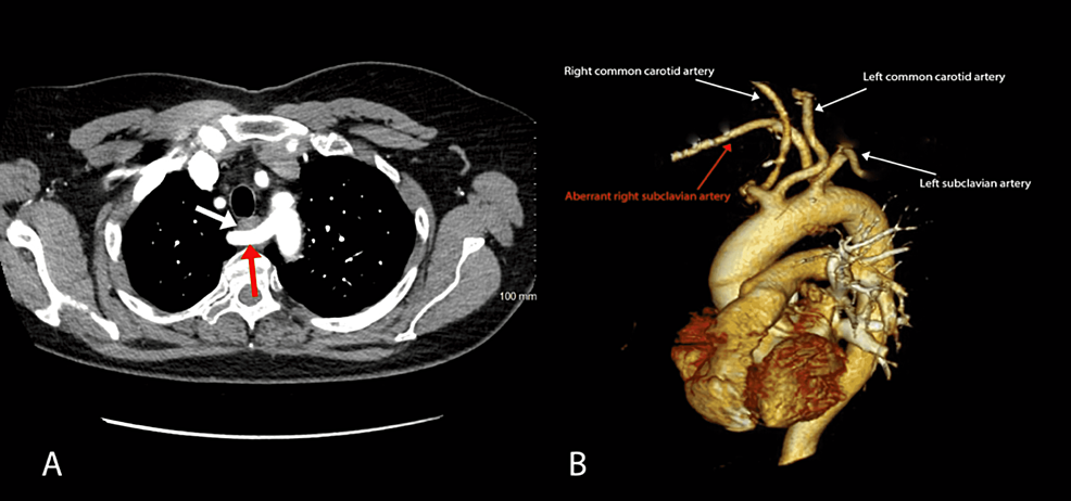 (A)-CT-angiography-scan-showing-aberrant-right-subclavian-artery-(red-arrow)-coursing-posterior-to-the-esophagus-(white-arrow),-resulting-in-extrinsic-compression.-(B)-Three-dimensional-CT-scan-showing-the-heart-and-aortic-arch.-The-right-subclavian-artery-(highlighted-in-red)-arises-as-the-last-branch-from-the-aortic-arch-distal-to-the-origin-of-the-left-subclavian-artery.
