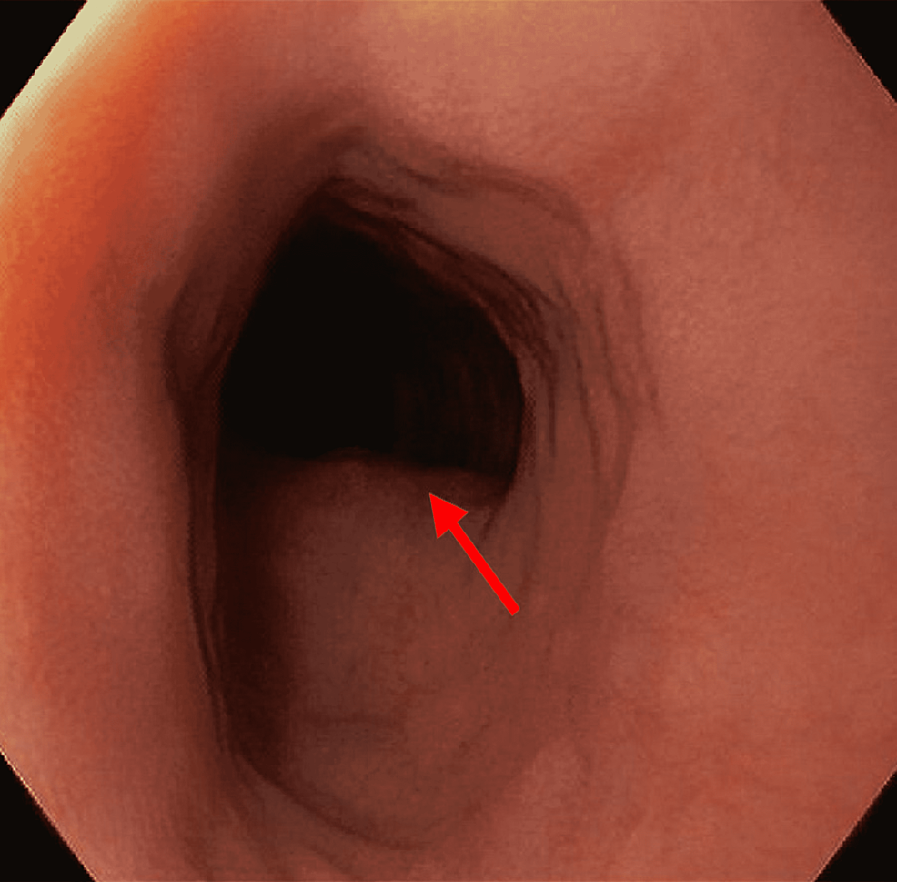 EGD-showing-external-compression-(red-arrow)-posterior-to-the-esophagus
