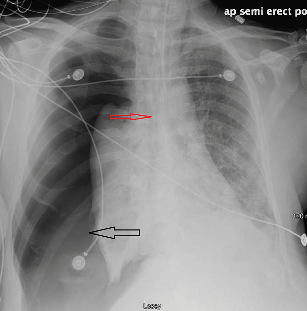 Significant-right-sided-tension-pneumothorax-(black-arrow)-with-displacement-of-mediastinal-structures-towards-the-opposite-side-of-pneumothorax-(red-arrow)