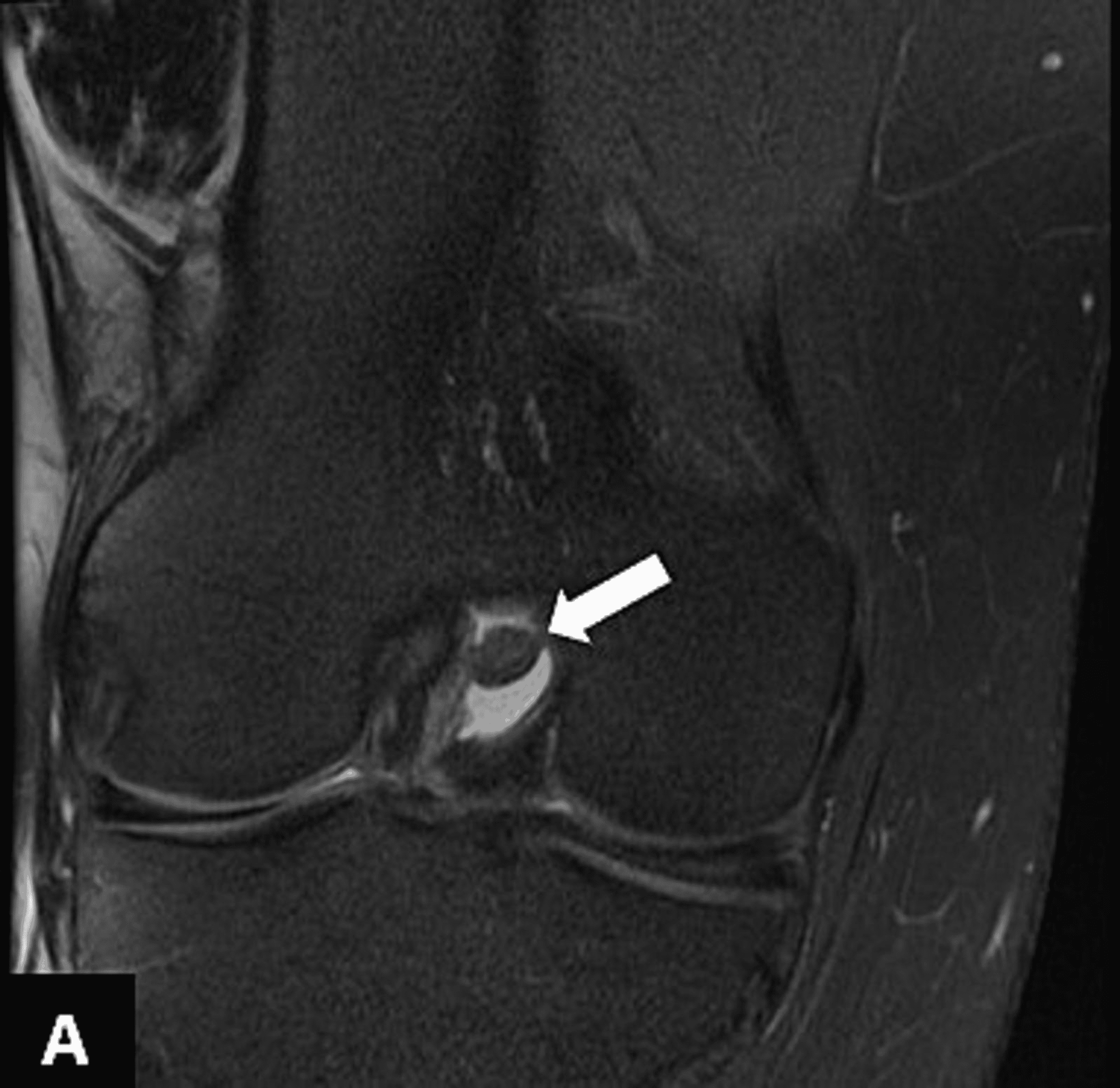 Cureus | A Rare Presentation of a True Intra-articular Lipoma: A Case ...