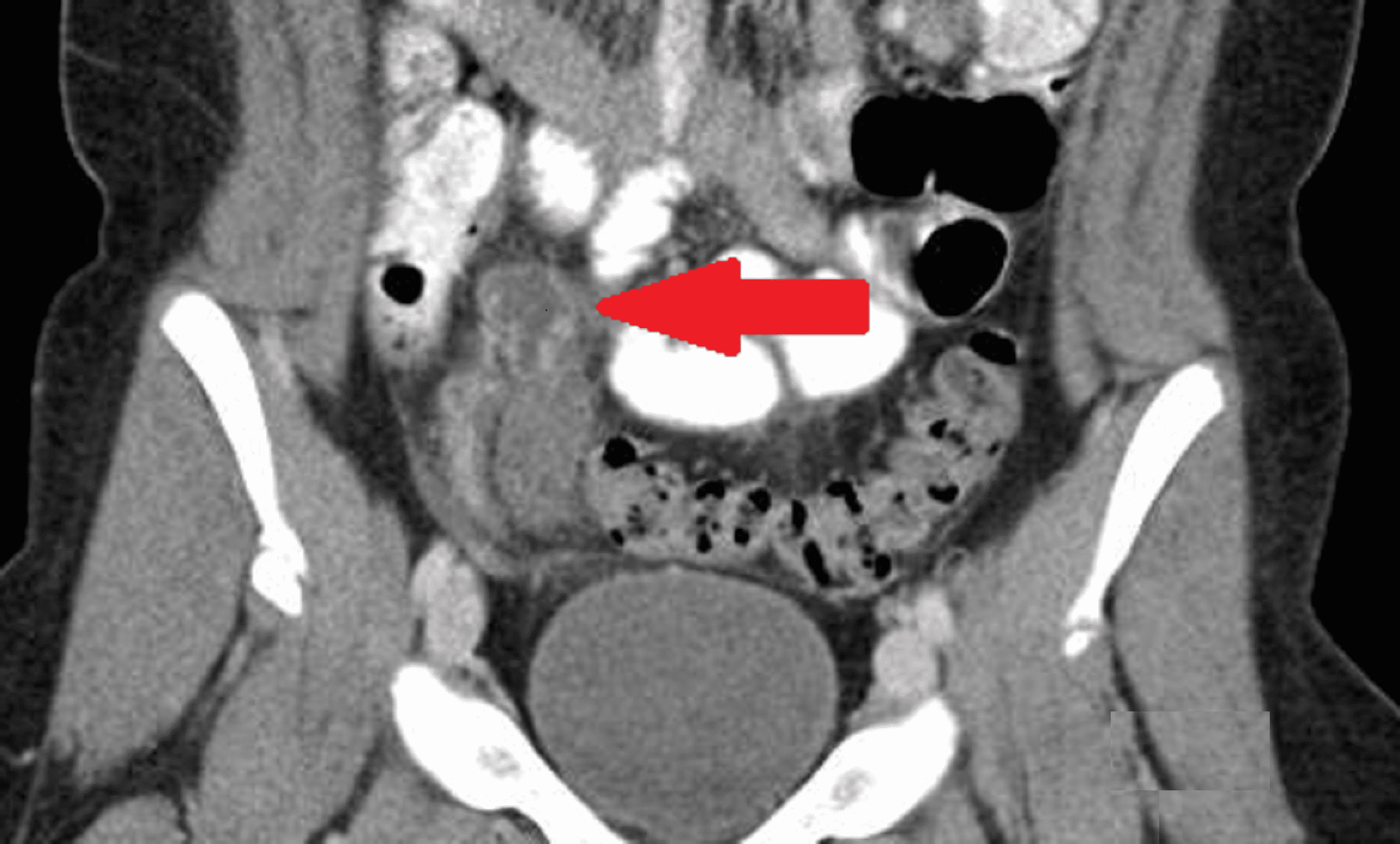 Cureus The Role of a Spinning Top Urethra in the Development of