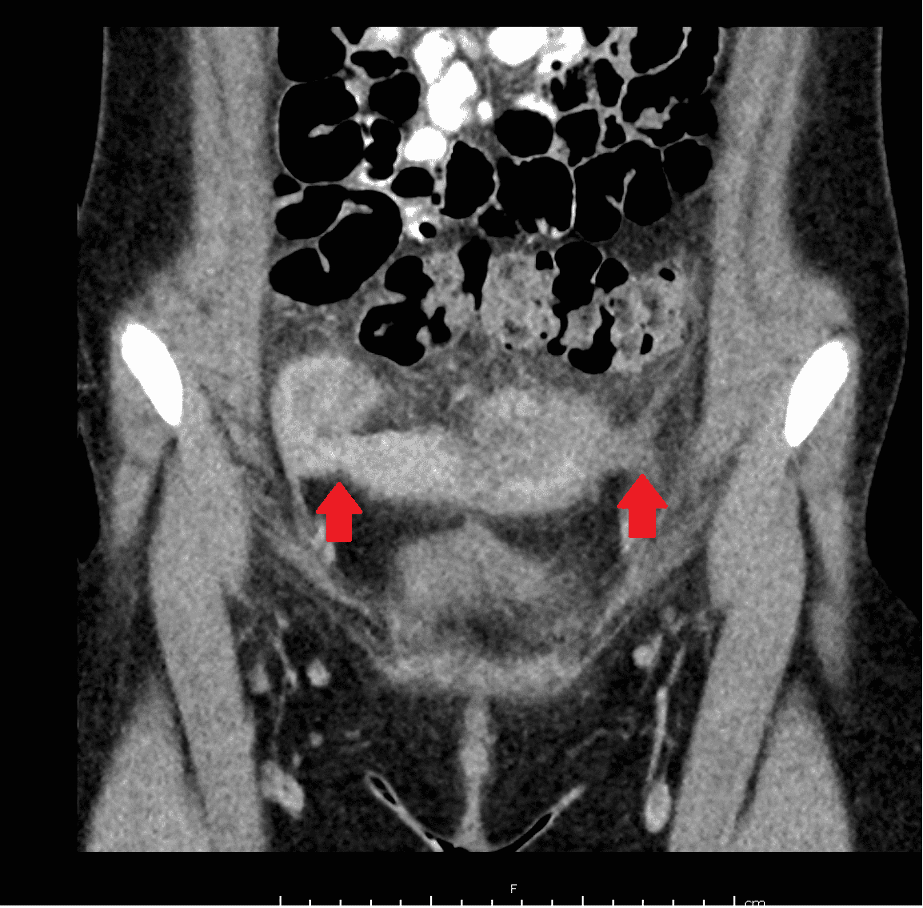 Cureus The Role of a Spinning Top Urethra in the Development of