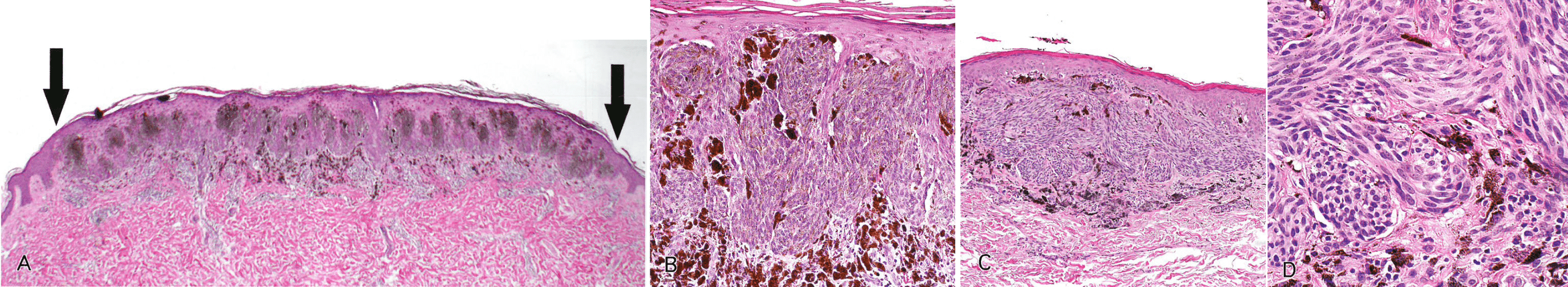 Cureus | Recognizing Histopathological Simulators of Melanoma to Avoid ...