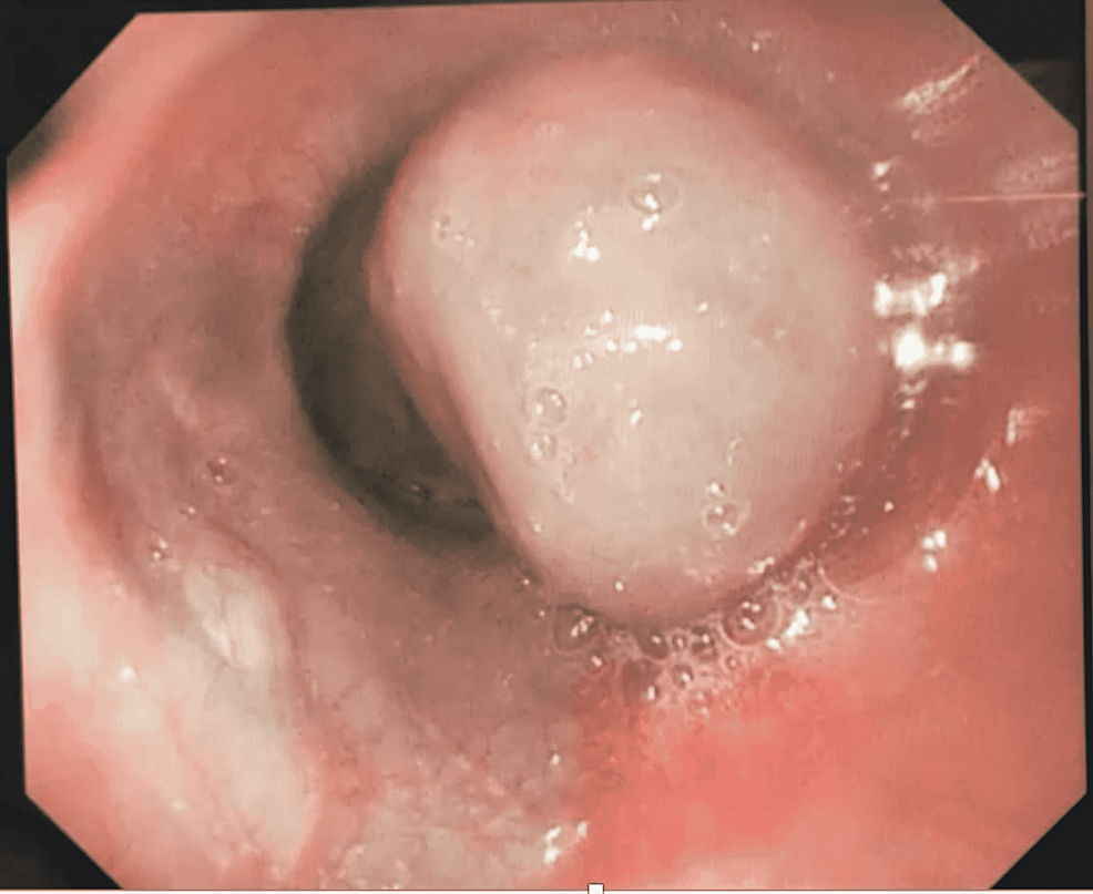 Endoscopic-image-of-the-3-cm-distal-esophageal-subepithelial-mass