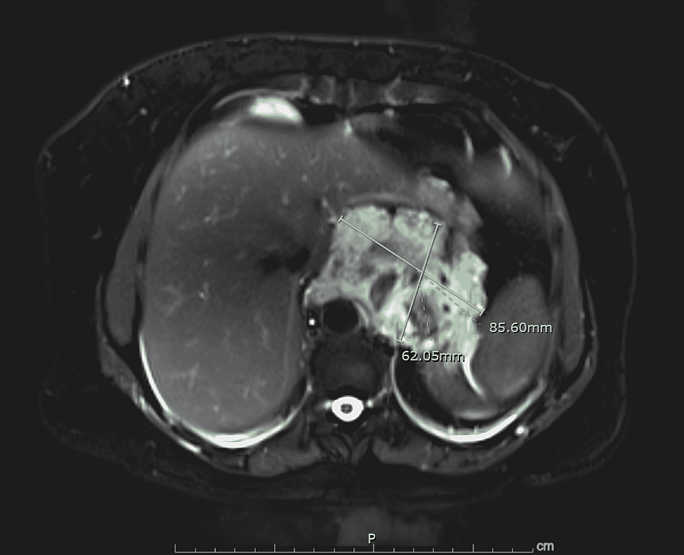MRI-abdomen-showing-low-flow-distal-esophageal--hemangioma-