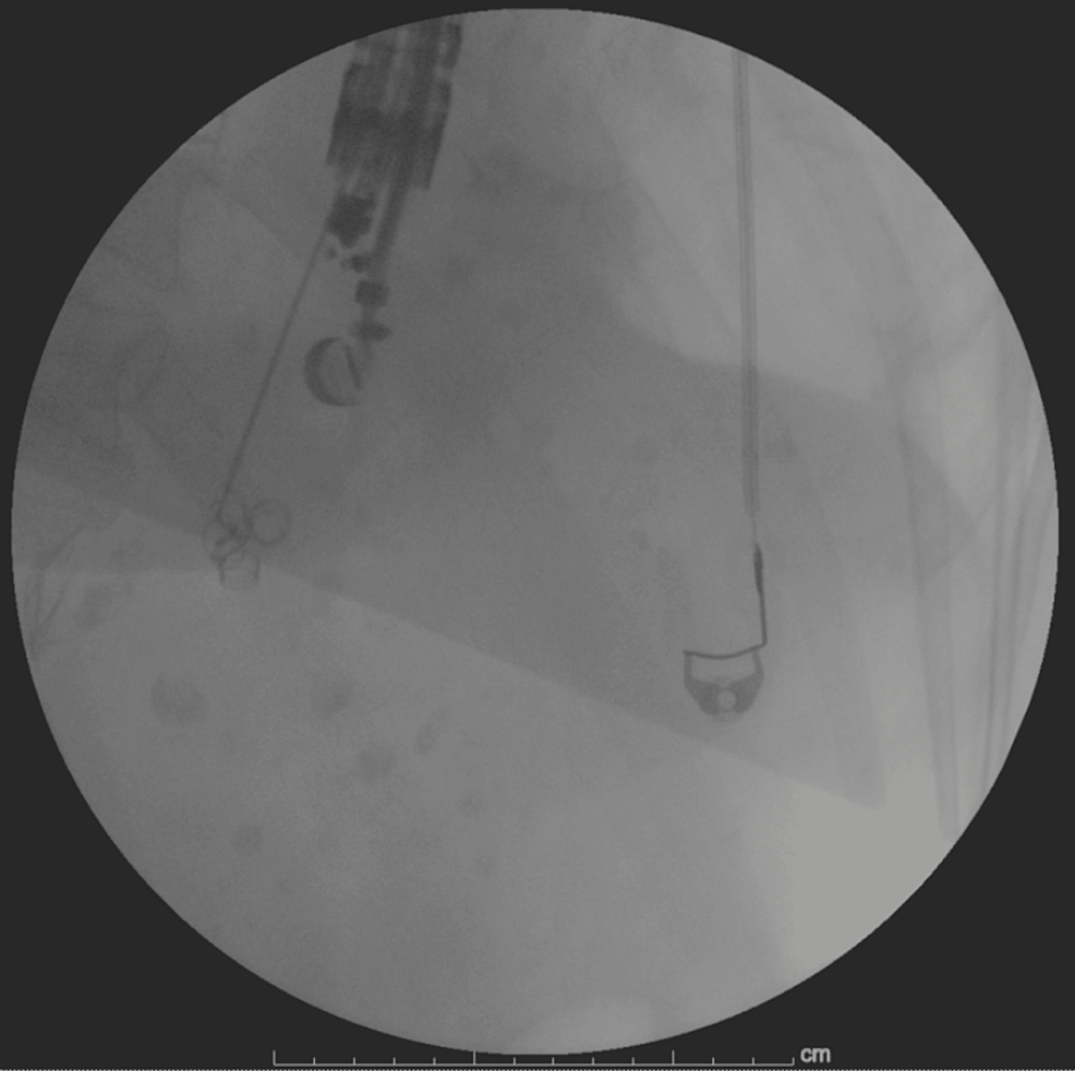 Fluoroscopic-image-of-EUS-guided-coil-placement
