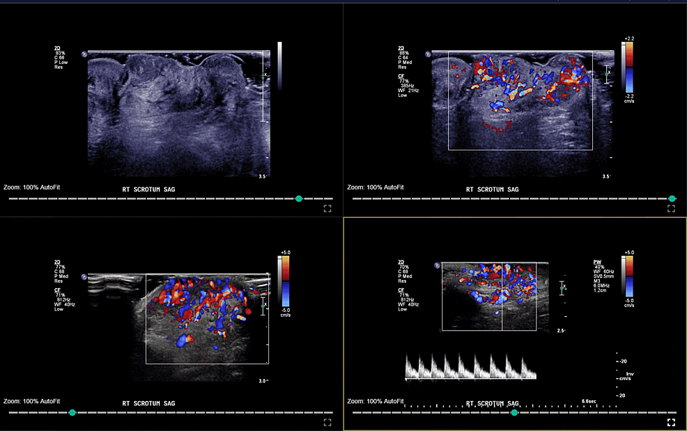 Doppler-ultrasonography-scan-of-the-scrotum-showing-the-heterogeneous-hypervascular-lesion