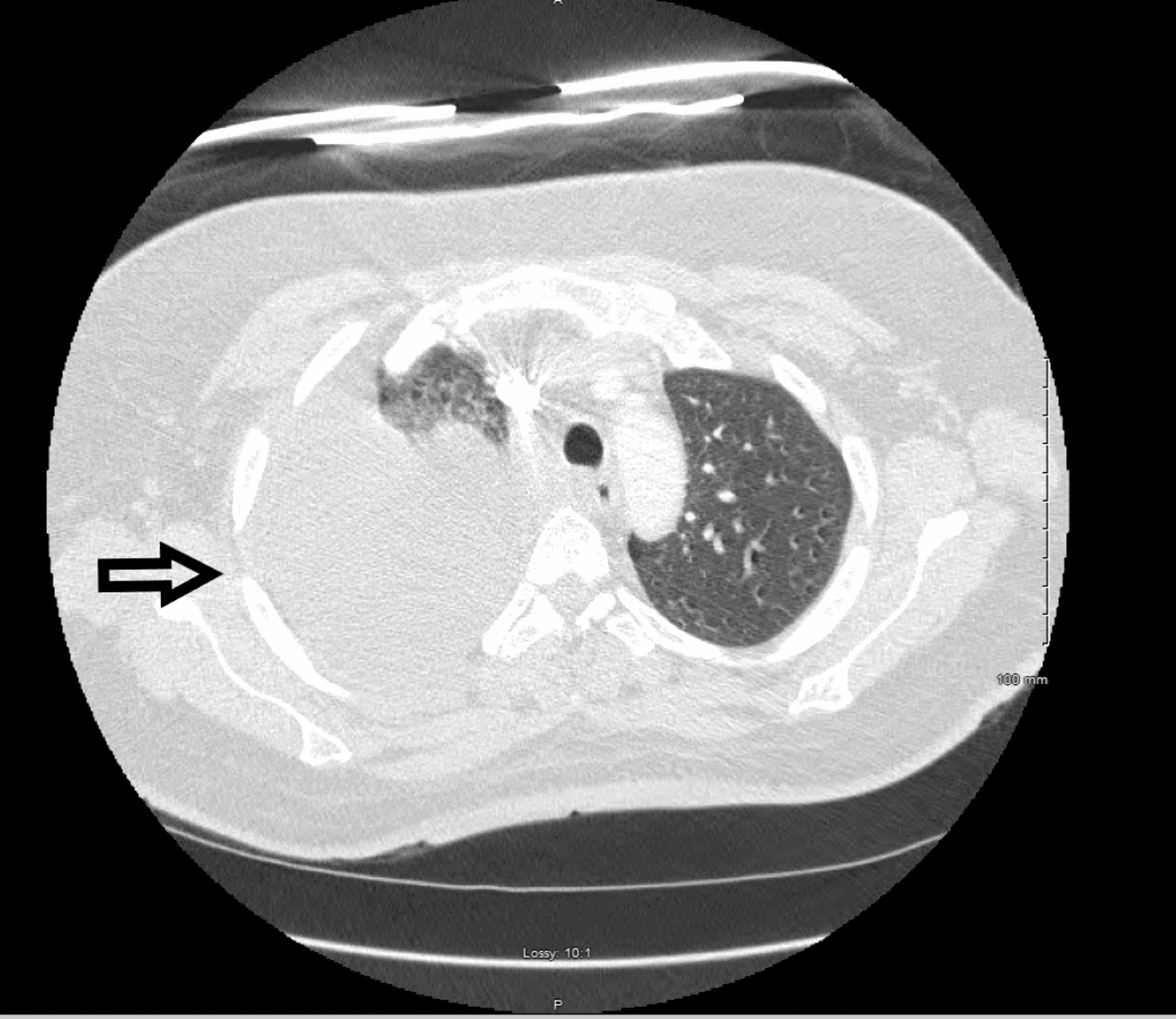 Cureus Urinothorax A Rare Cause Of Pleural Effusion