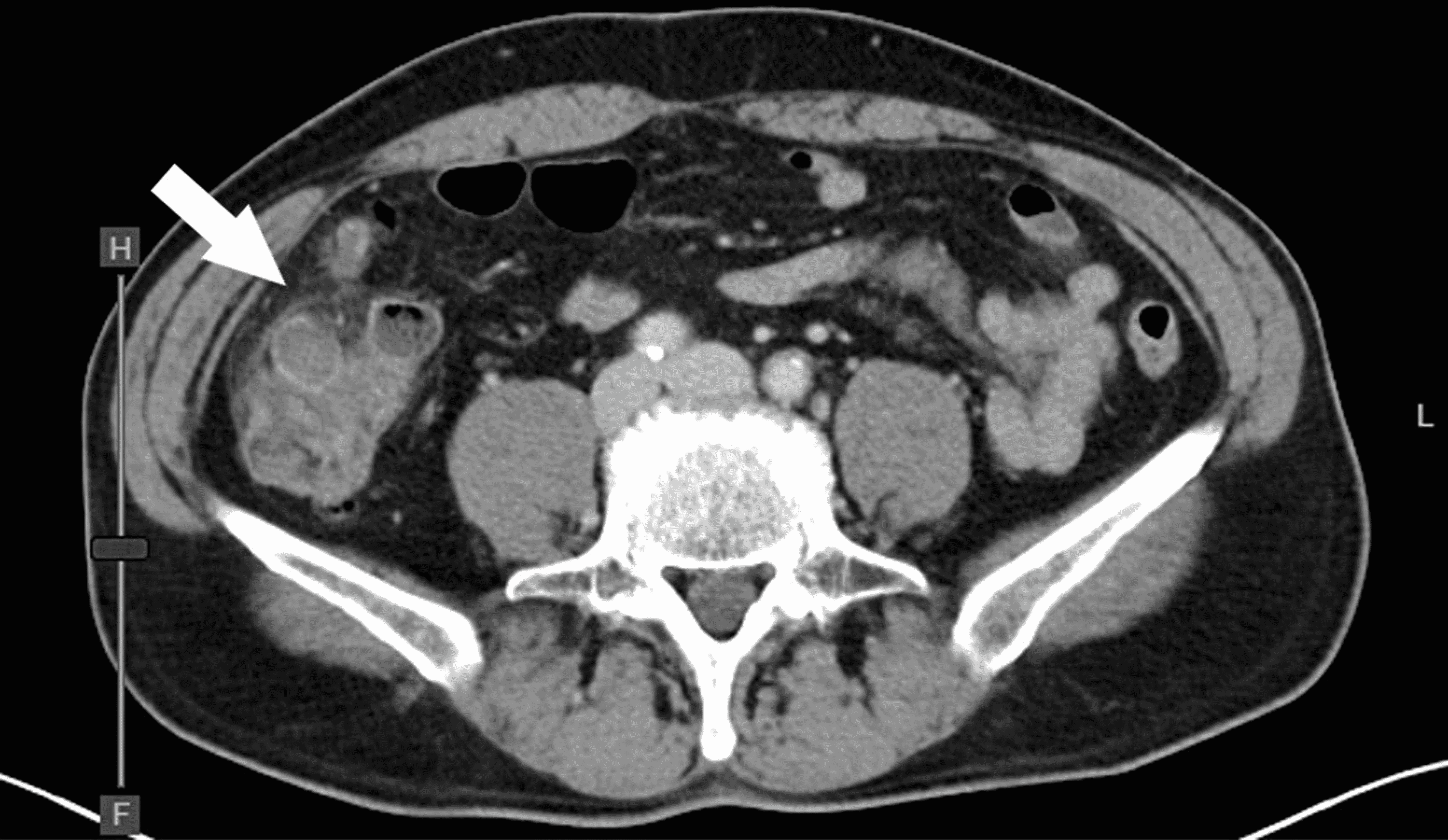 Cureus A Case Of Cecal Diverticulitis Complicated By Pseudoaneurysm In The Ileocolic Artery 0209