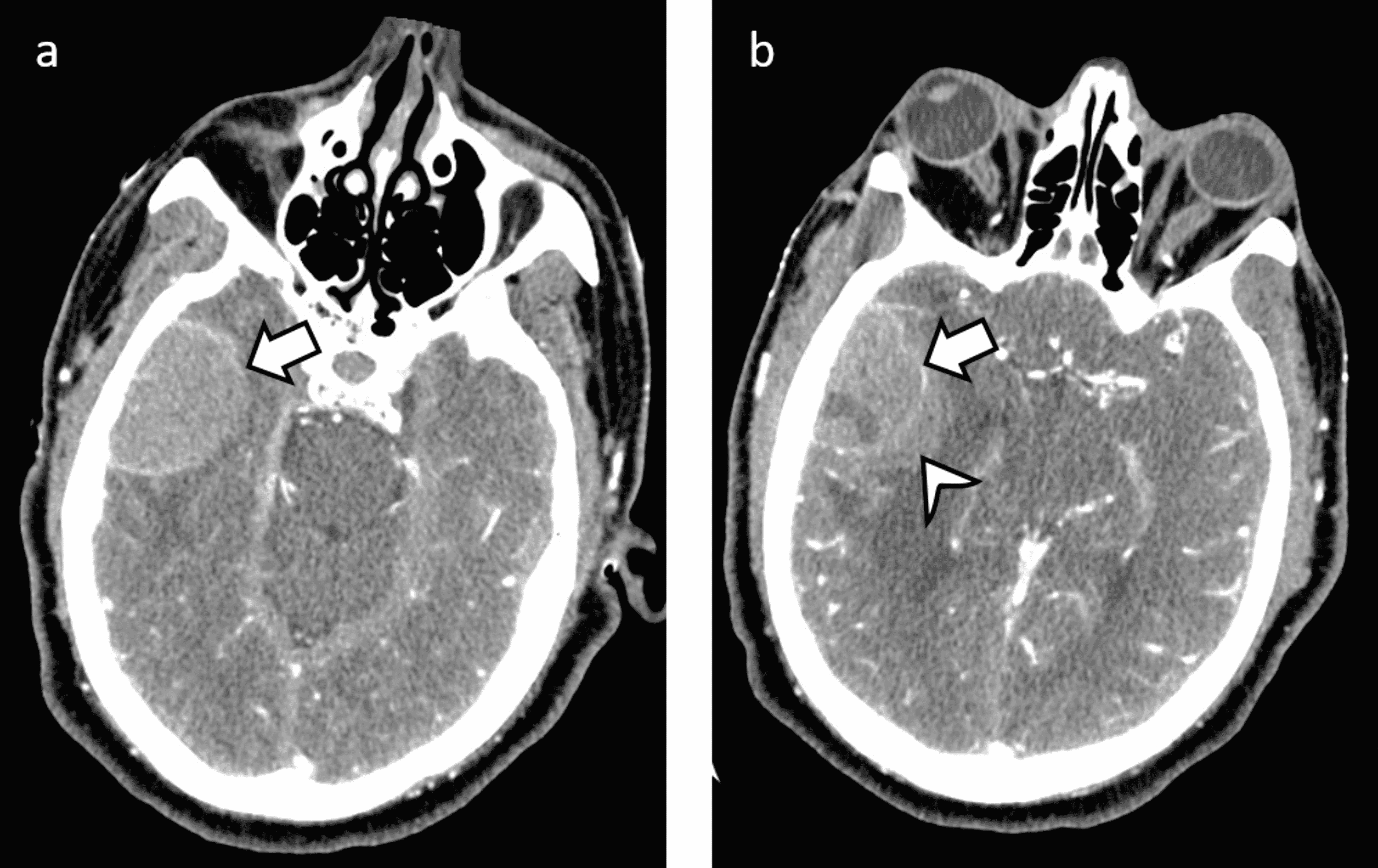 Cureus | Meningiomas Can Present As Intracranial Hemorrhage In Rare ...