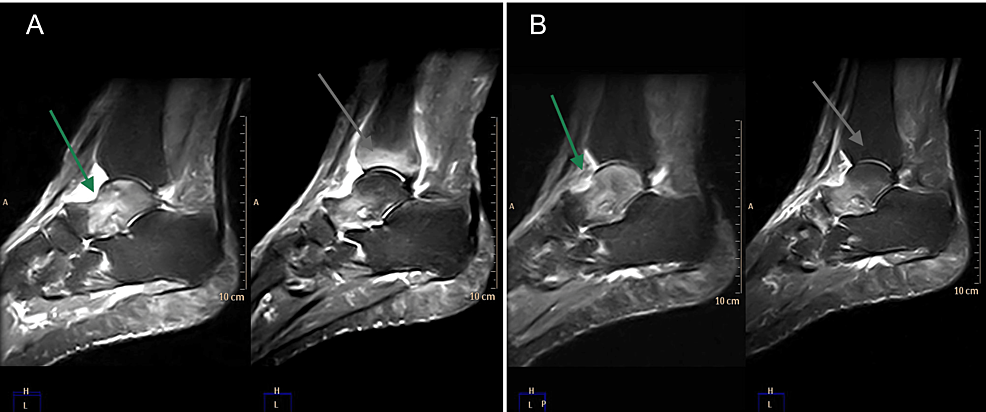Magnetic-resonance-imaging-of-tibiotarsal-joints-before-(A)-and-after-(B)-the-treatment-with-neridronate,-with--improvement-of-bone-edema-(grey-arrow)-and-synovitis-(green-arrow).