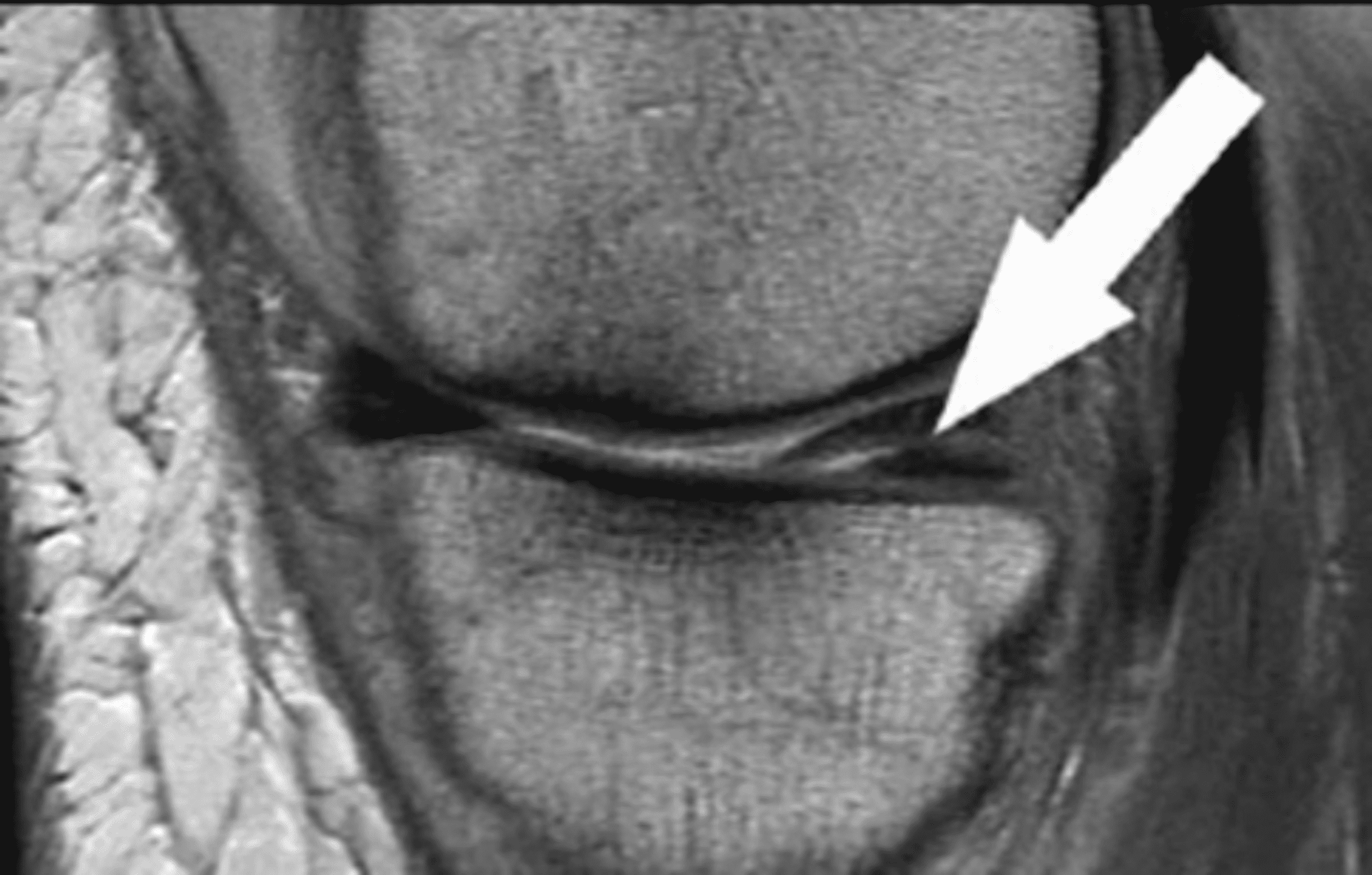 Cureus Meniscus Tear Pathology, Incidence, and Management