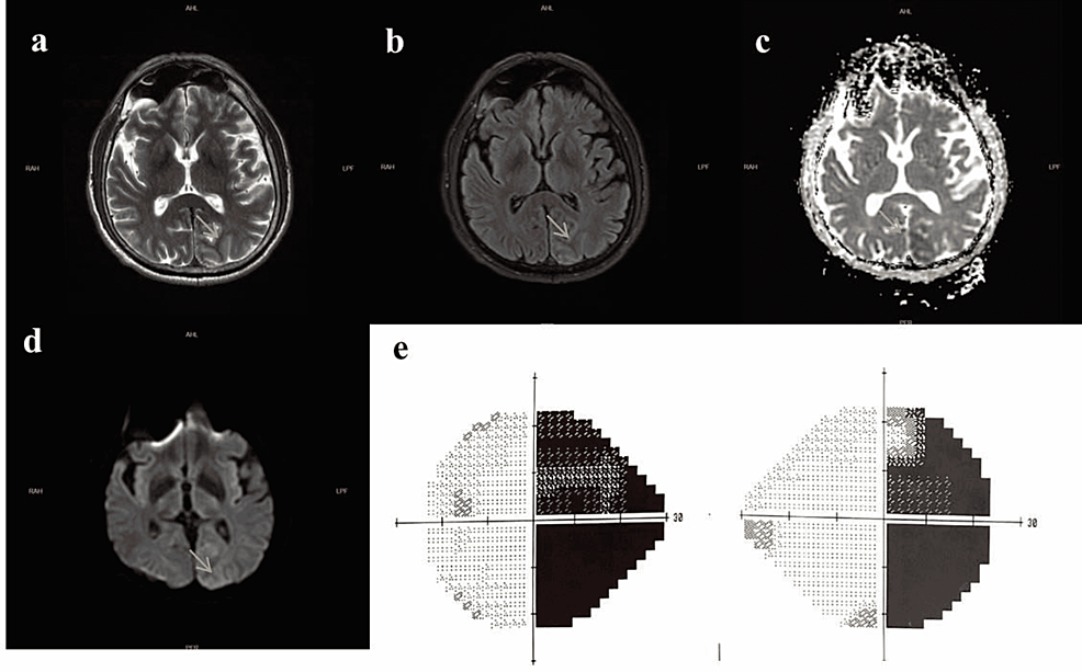 Patient's-MRI-and-visual-field-test