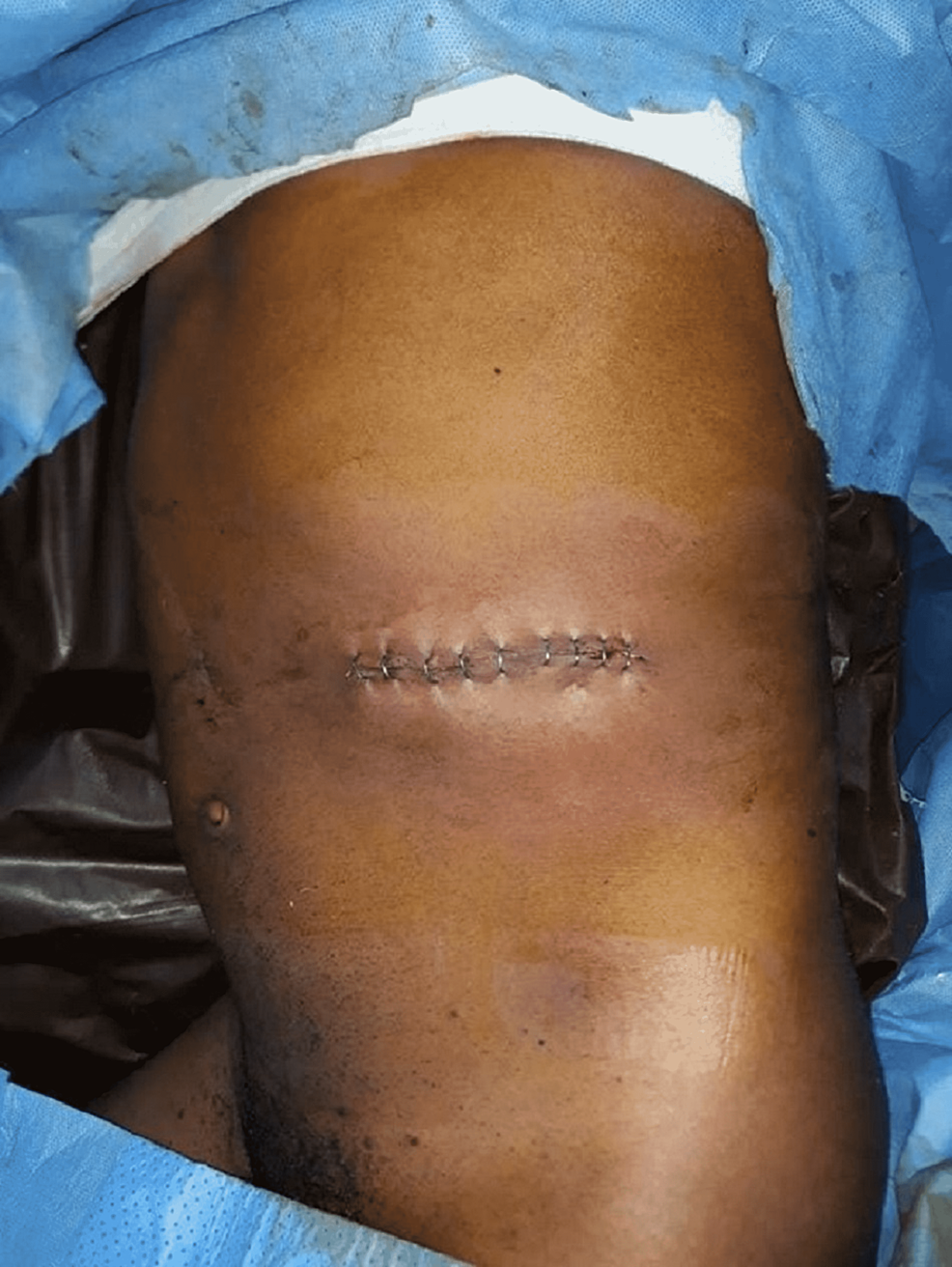 kidney transplant scar
