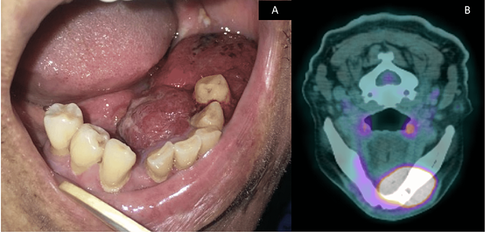 (A)-Intraoral-photograph-shows-a-large-growth-involving-the-left-side-floor-of-the-mouth-extending-from-the-midline-to-the-edentulous-molar-region.-(B)-Photograph-shows-PET-CT-image-(axial-cut)-of-the-primary-tumor-in-the-left-side-body-of-the-mandible