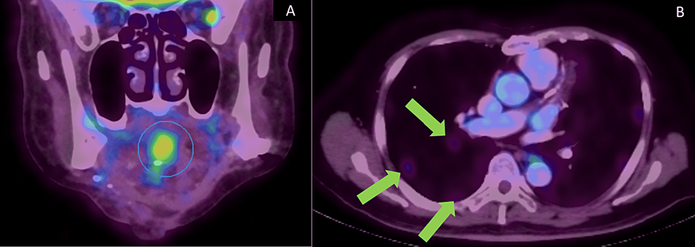 Photograph-shows-PET-CT-image-(A)-of-the-recurrent-tumor-on-the-base-of-the-tongue-(blue-circle)-and-(B)-three-metastatic-nodules-in-the-right-lung-(green-arrows)