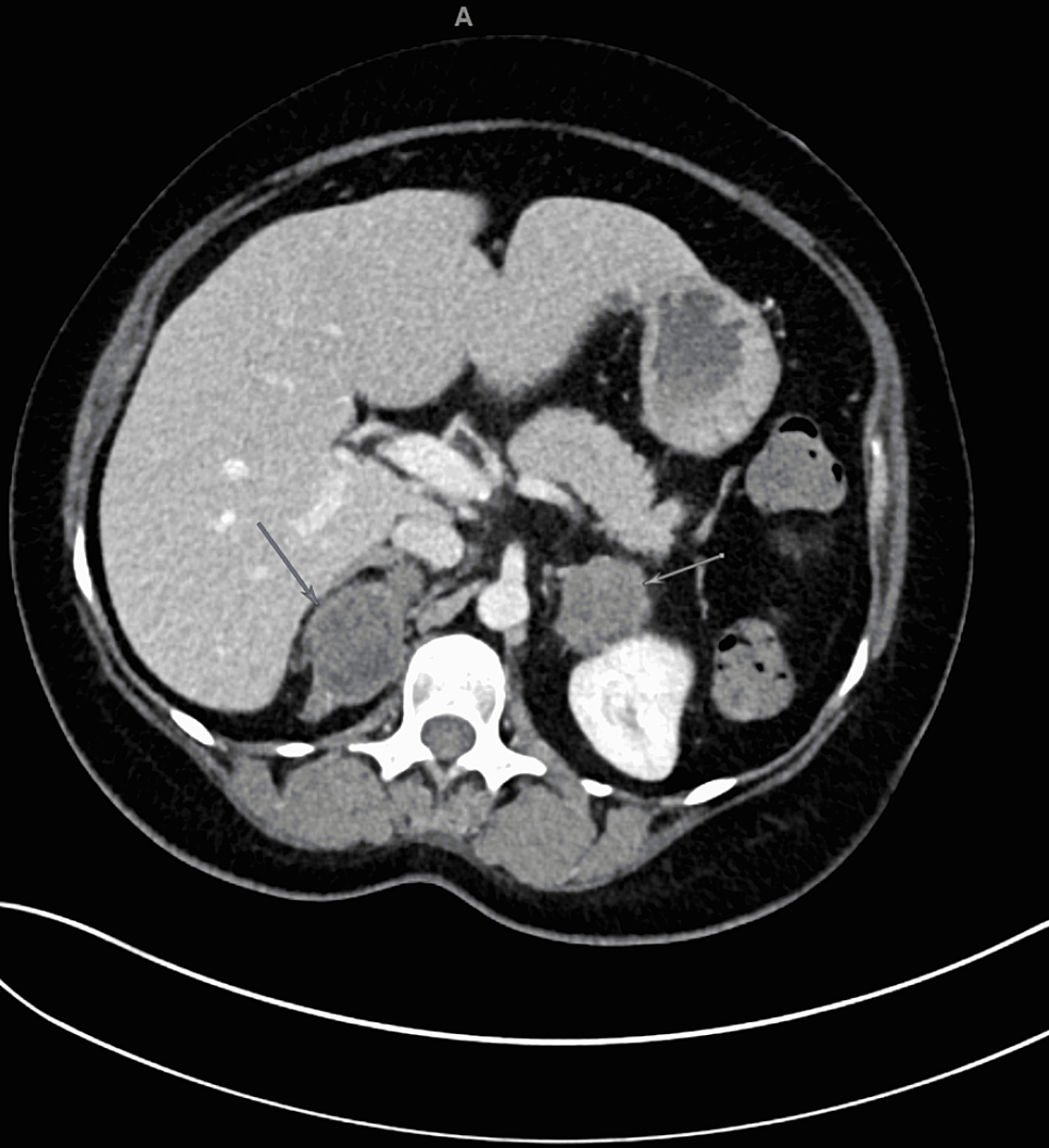 CT-of-the-abdomen/pelvis-with-contrast-showing-low-attenuation-masses-present-in-both-adrenal-glands-measuring-6.9-x-5.3-cm-on-the-right-(dark-gray-arrow)-and-4.5-x-3.9-cm-on-the-left-(light-gray-arrow)