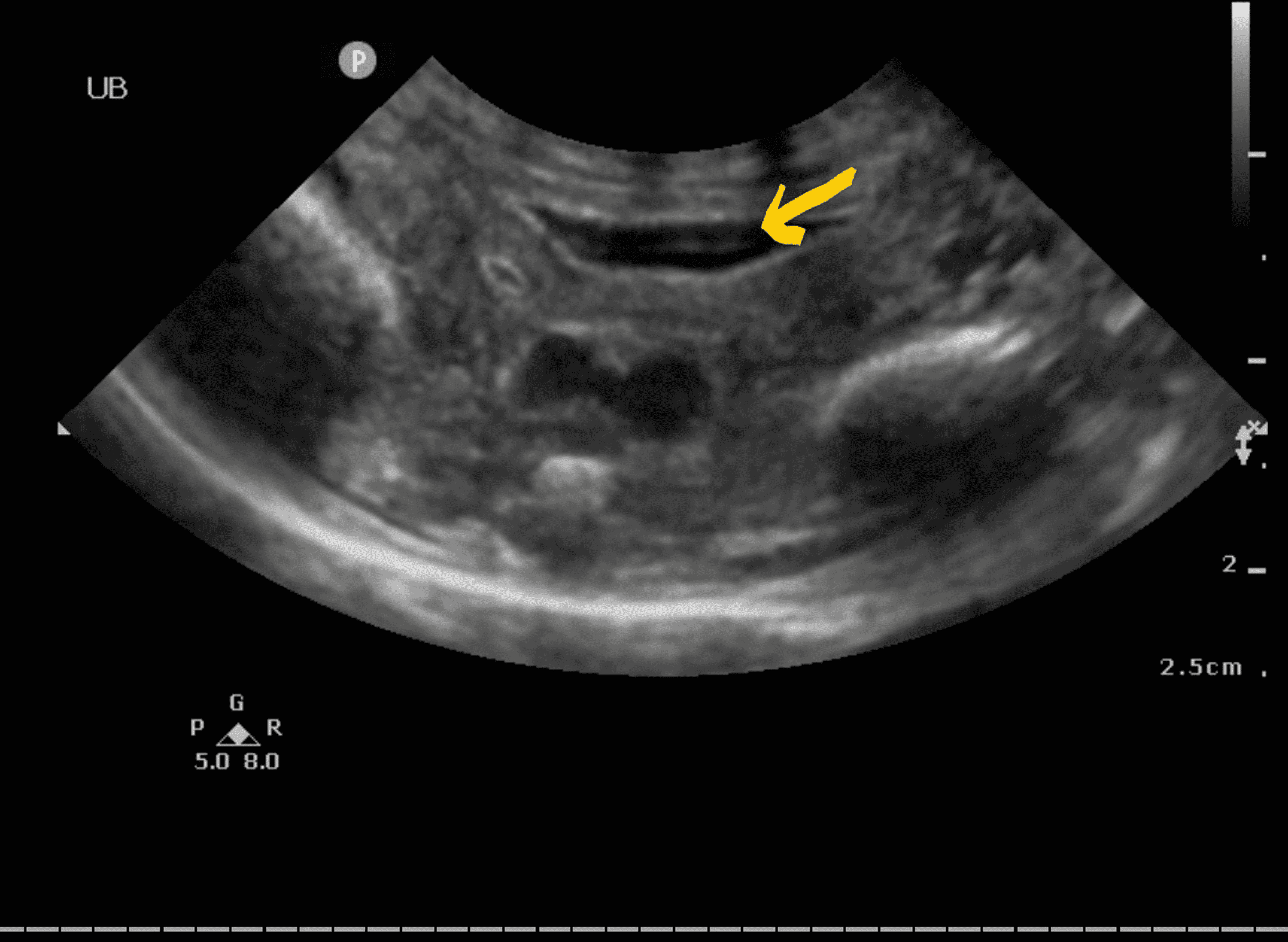 Cureus A Rare Cause of Ascites in Preterm Baby A Case Report