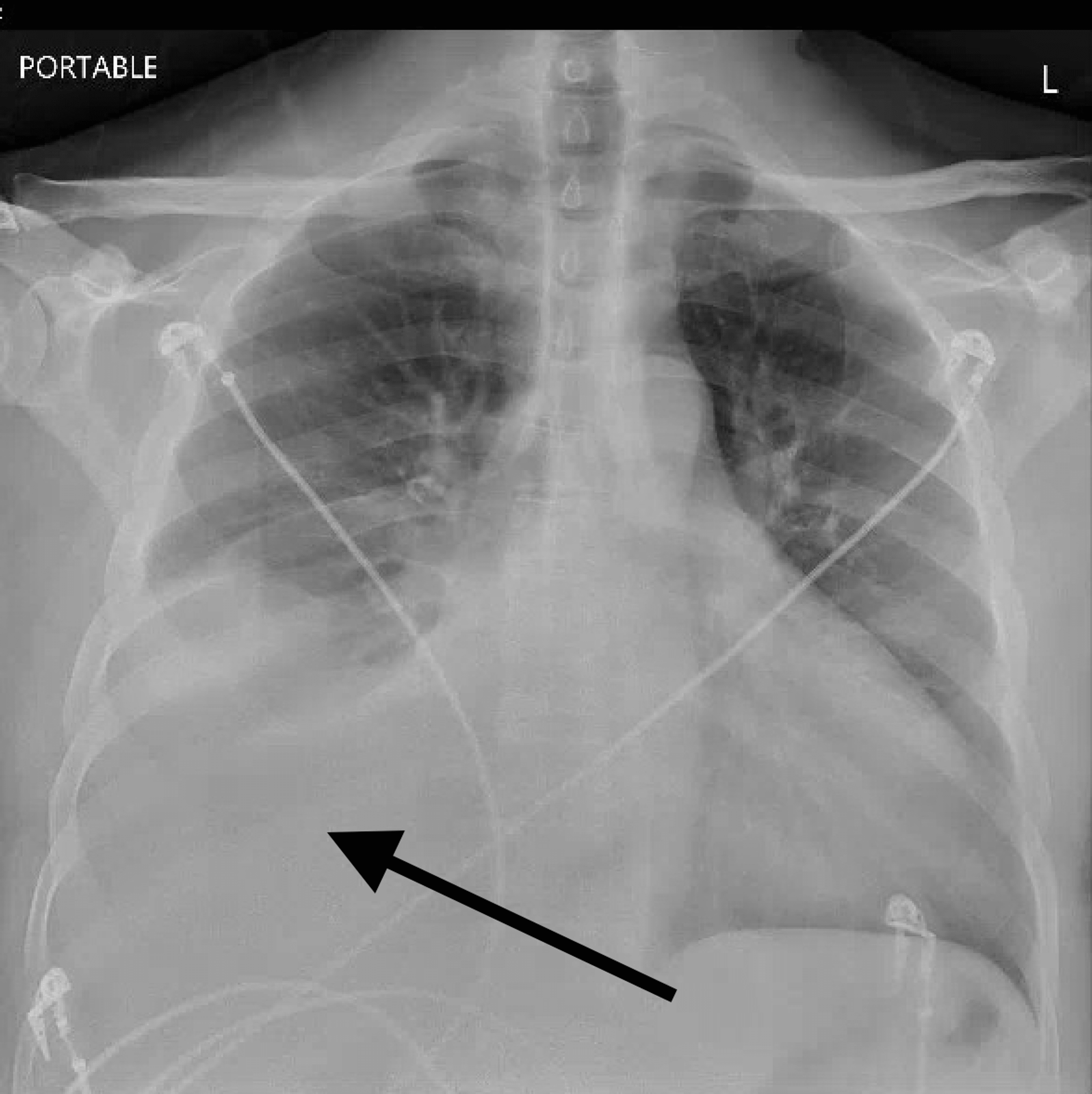 Heart Failure as the Initial Presentation of Multiple