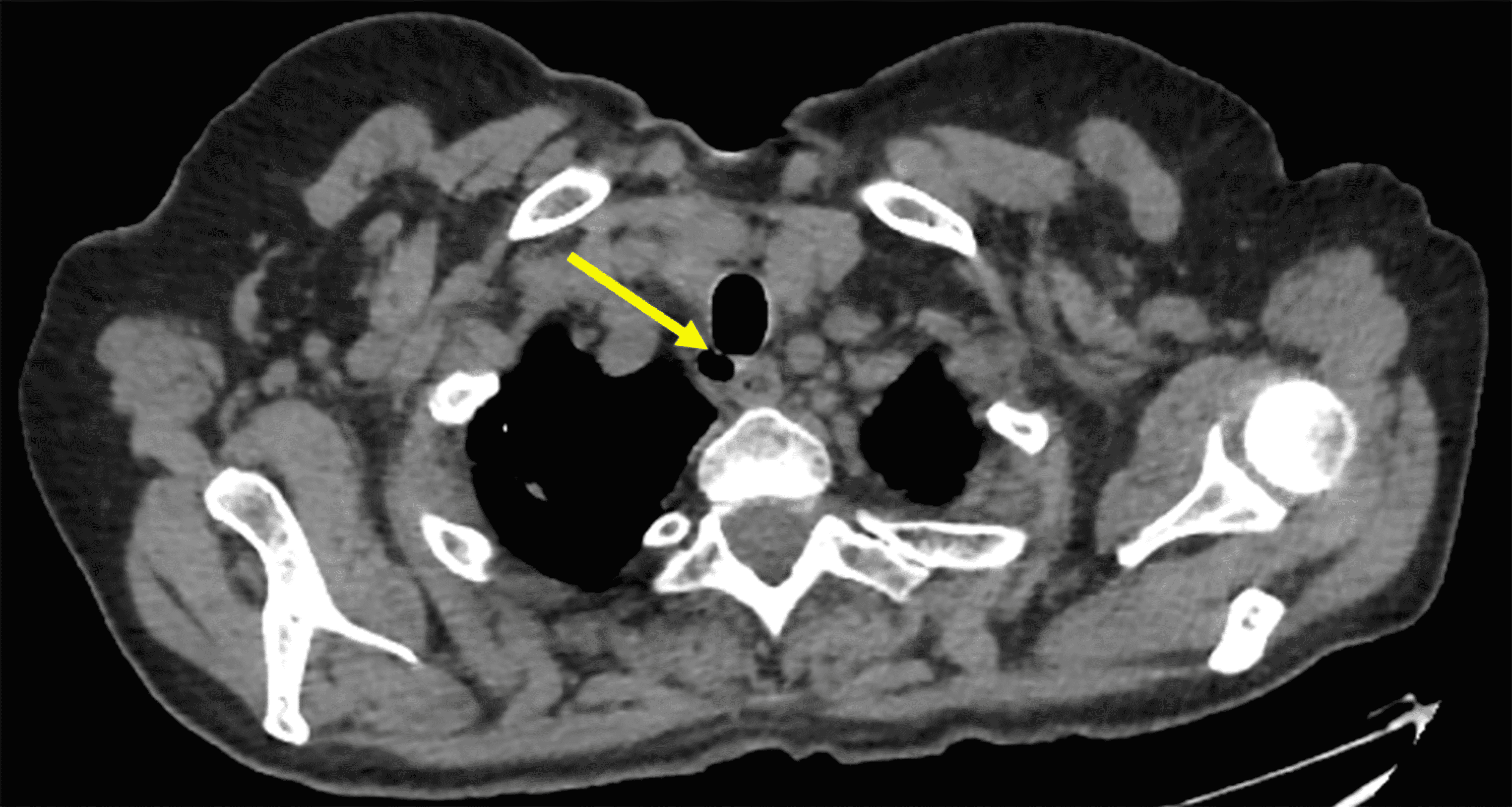 Cureus Chronic Cough Revealing a Tracheal Diverticulum A Case Report