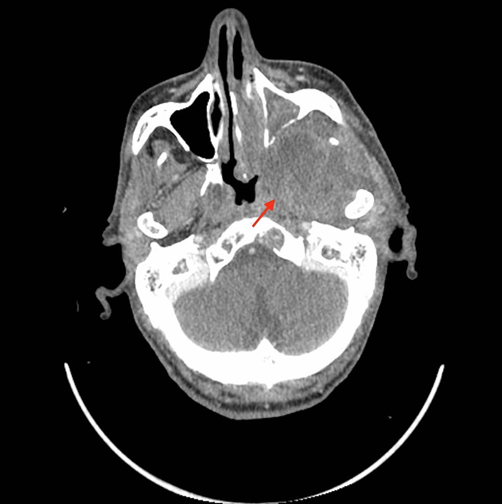 A-CT-scan-performed-six-months-after-the-end-of-radiation-therapy-showed-a-stable-disease,-with-a-residual-lesion-that-extends-to-the-infra-temporal-fossa-(arrow).