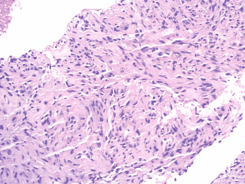 H&E-stain-showing-disorganized-and-bland-spindle-cells-associated-with-abundant-eosinophilic-cytoplasm