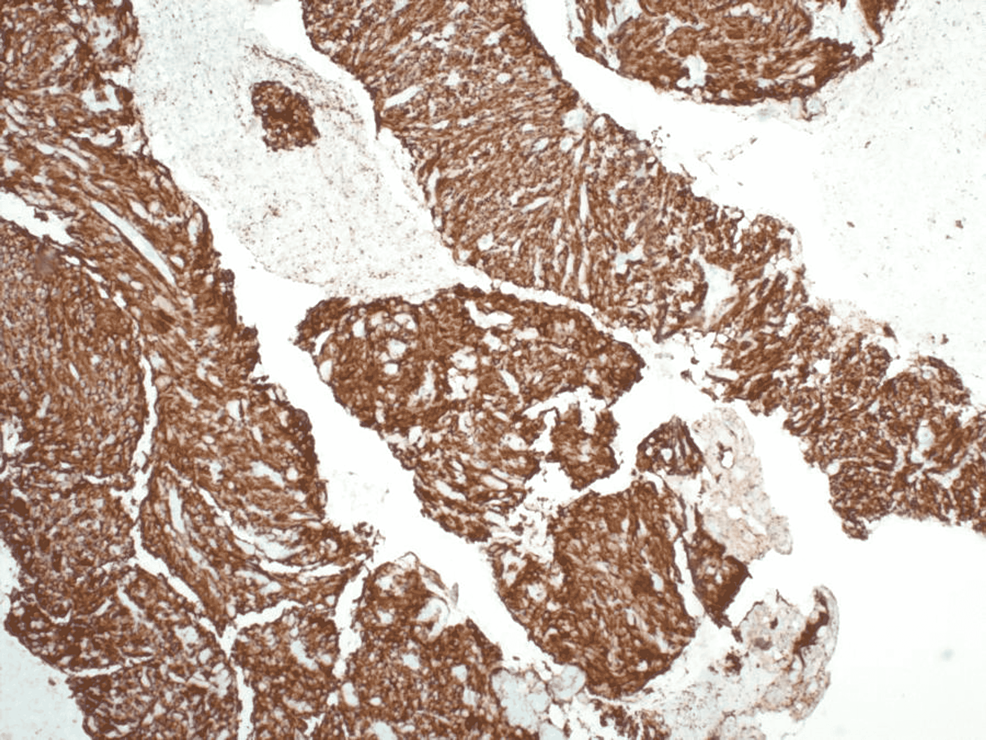 Immunohistochemistry-stain-showing-the-atypical-cells-diffusely-positive-for-CD117,-confirming-the-diagnosis-of-a-GIST
