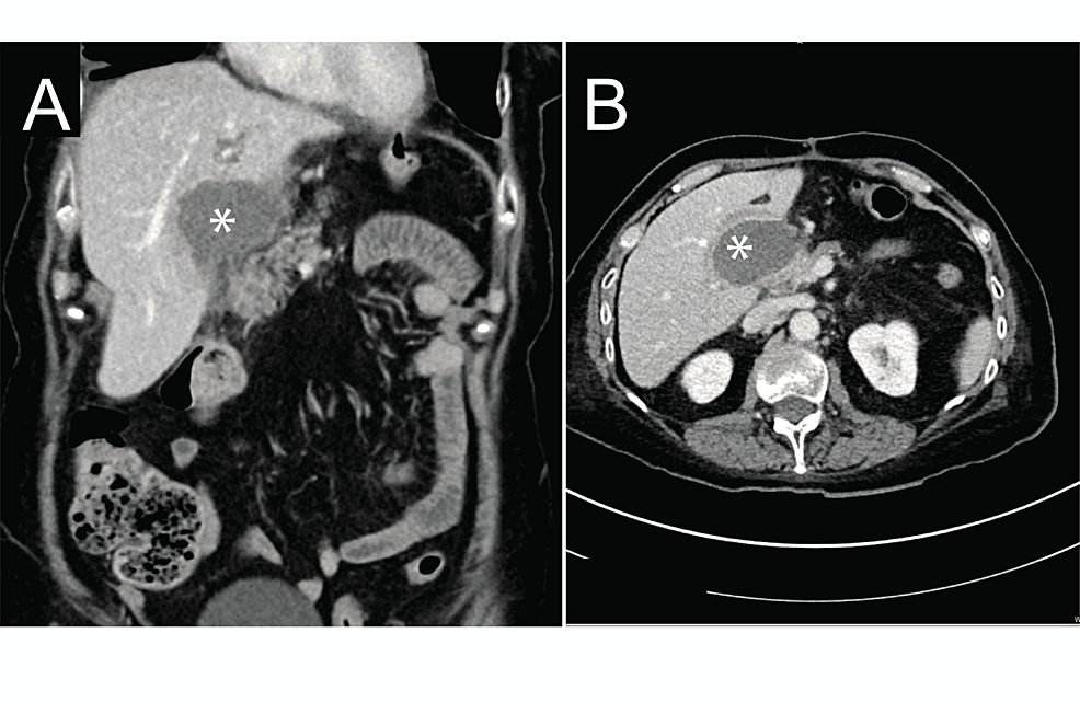 Abdominal-computed-tomographic-(CT)-scan.