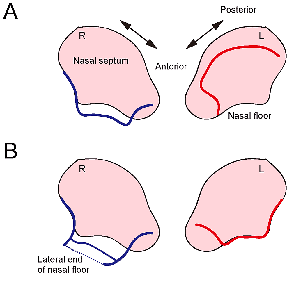 Incisions-on-both-septal-mucoperiosteum.