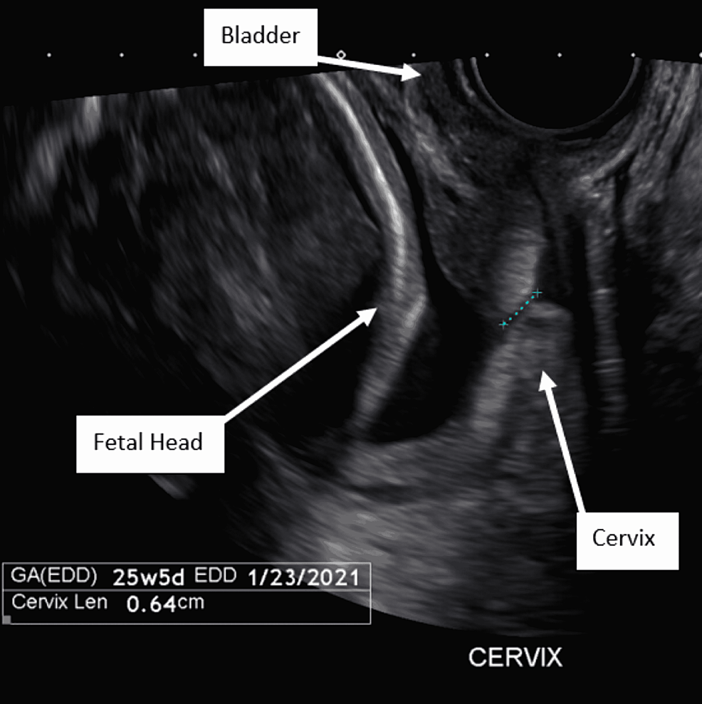 Bladder prolapse into vagina, Radiology Case