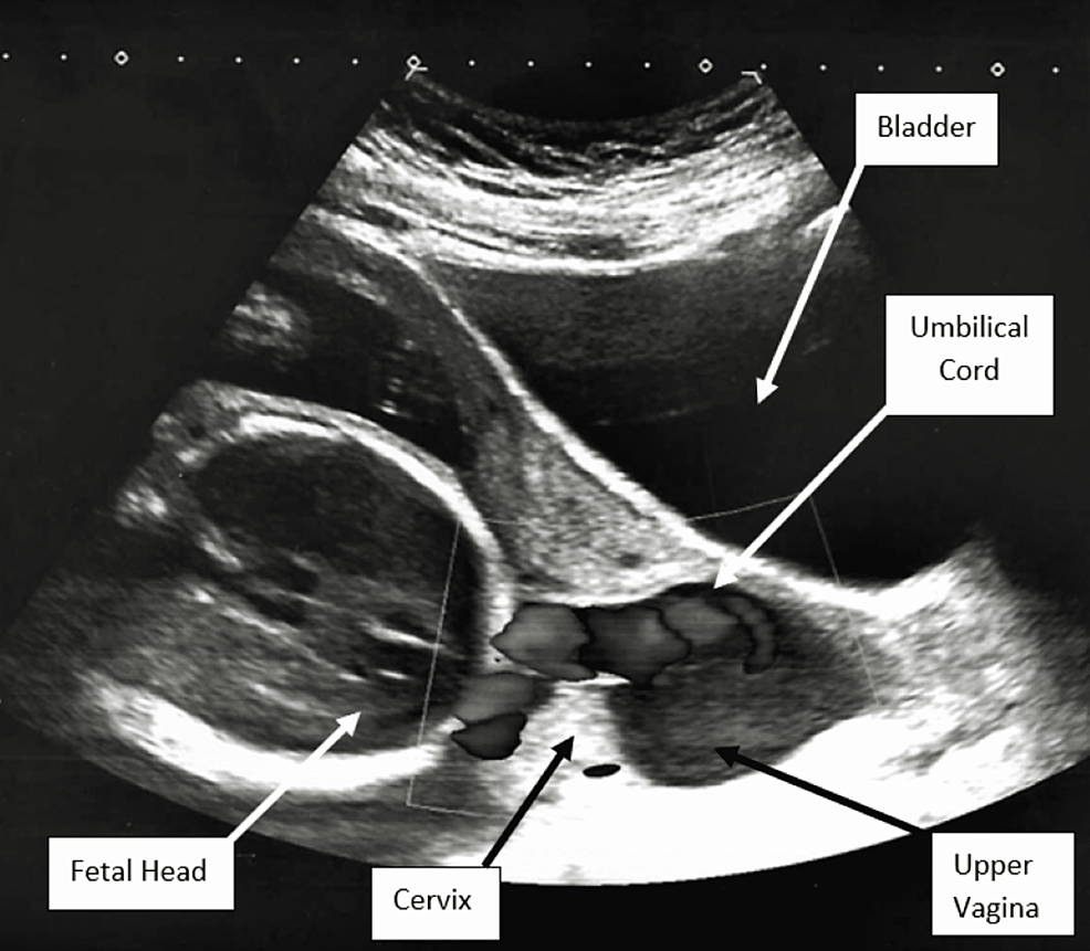 cord presentation ultrasound