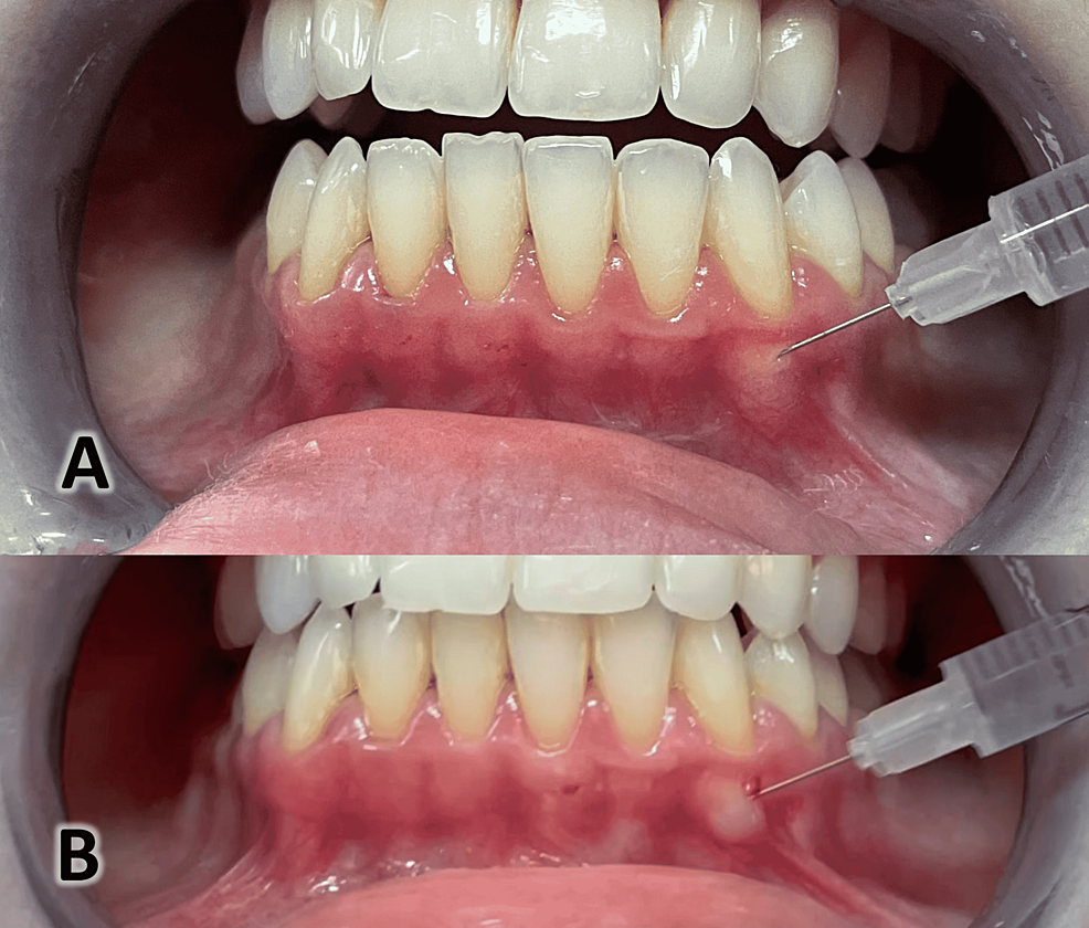 Evaluation of the Hyaluronic Acid Versus the Injectable PlateletRich