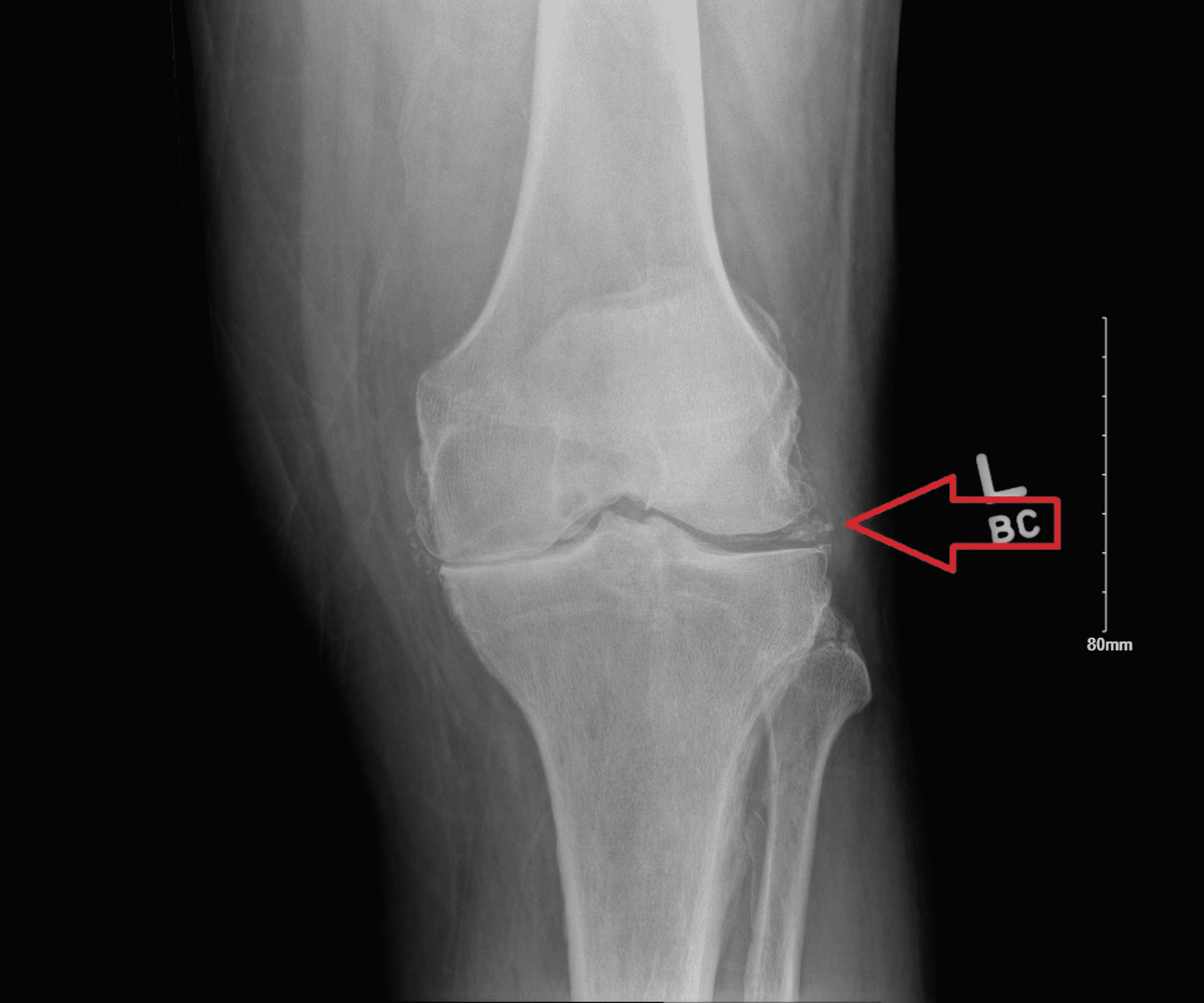 Cureus | Crowned Dens Syndrome: A Rare Complication of Calcium ...