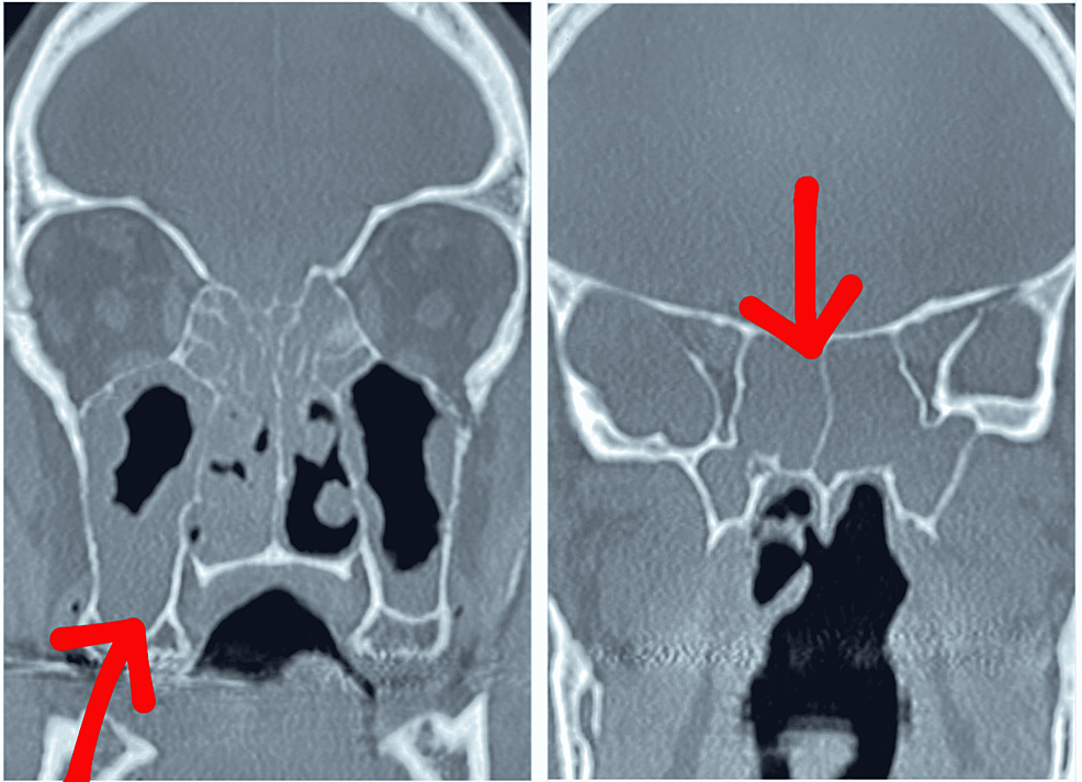 Pansinusitis-seen-on-CT-imaging-(red-arrows)