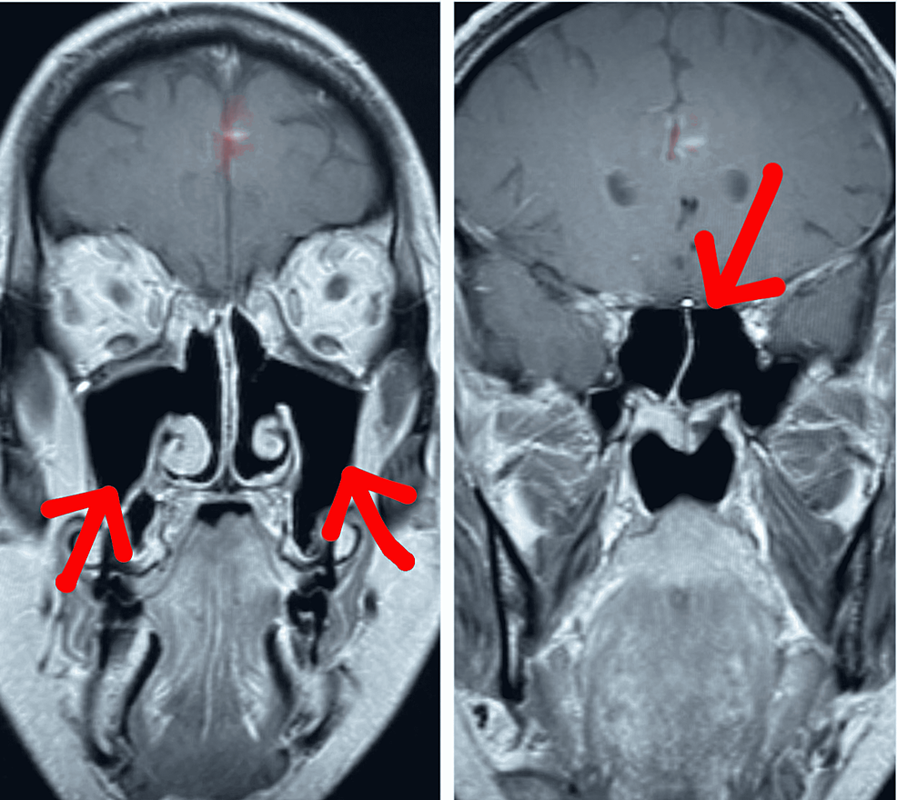 MRI-paranasal-sinuses-post-treatment-showing-resolution-of-sinusitis