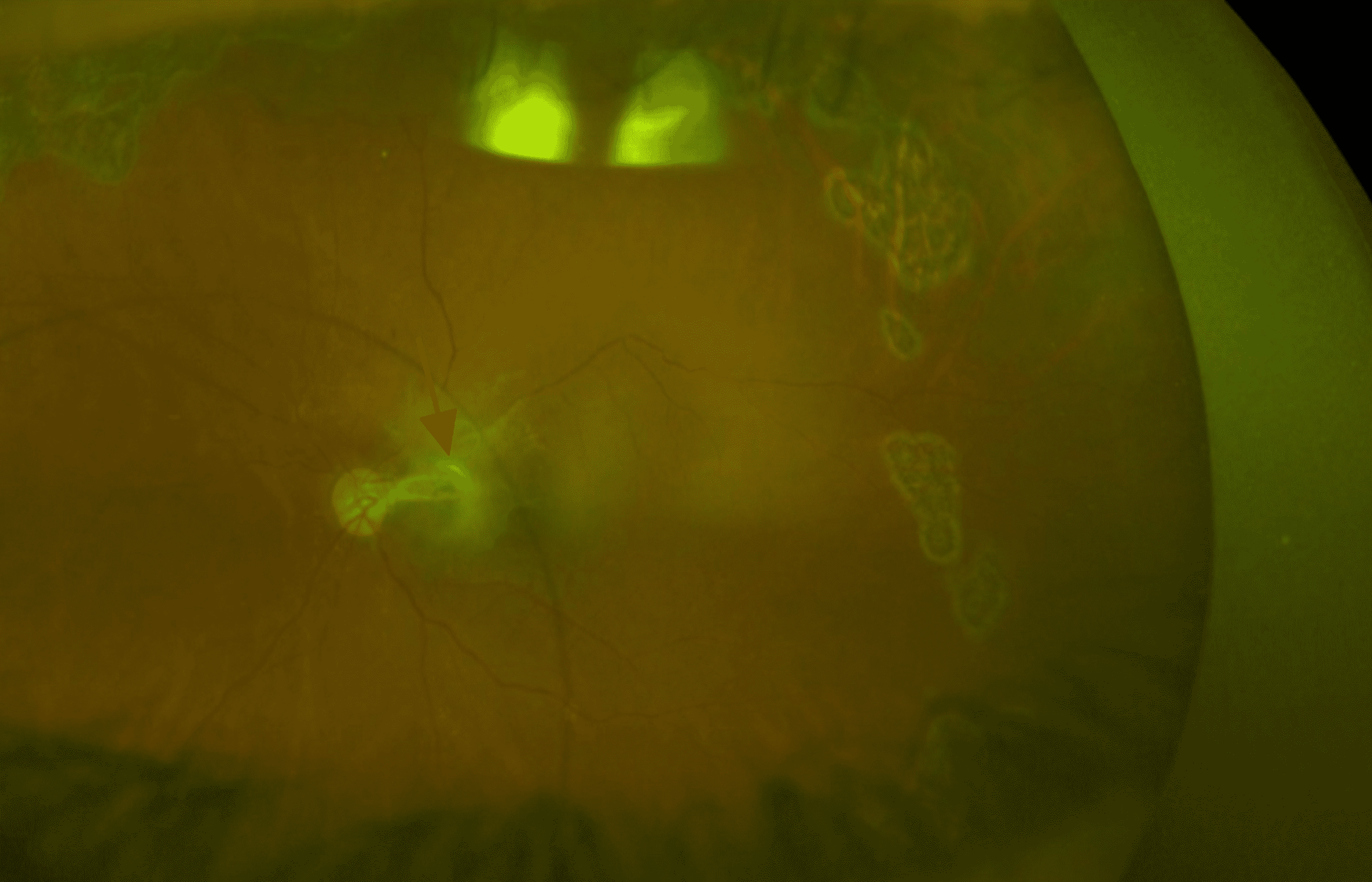 Cureus Optic Nerve Injury, Vitreous Hemorrhage, and Rhegmatogenous