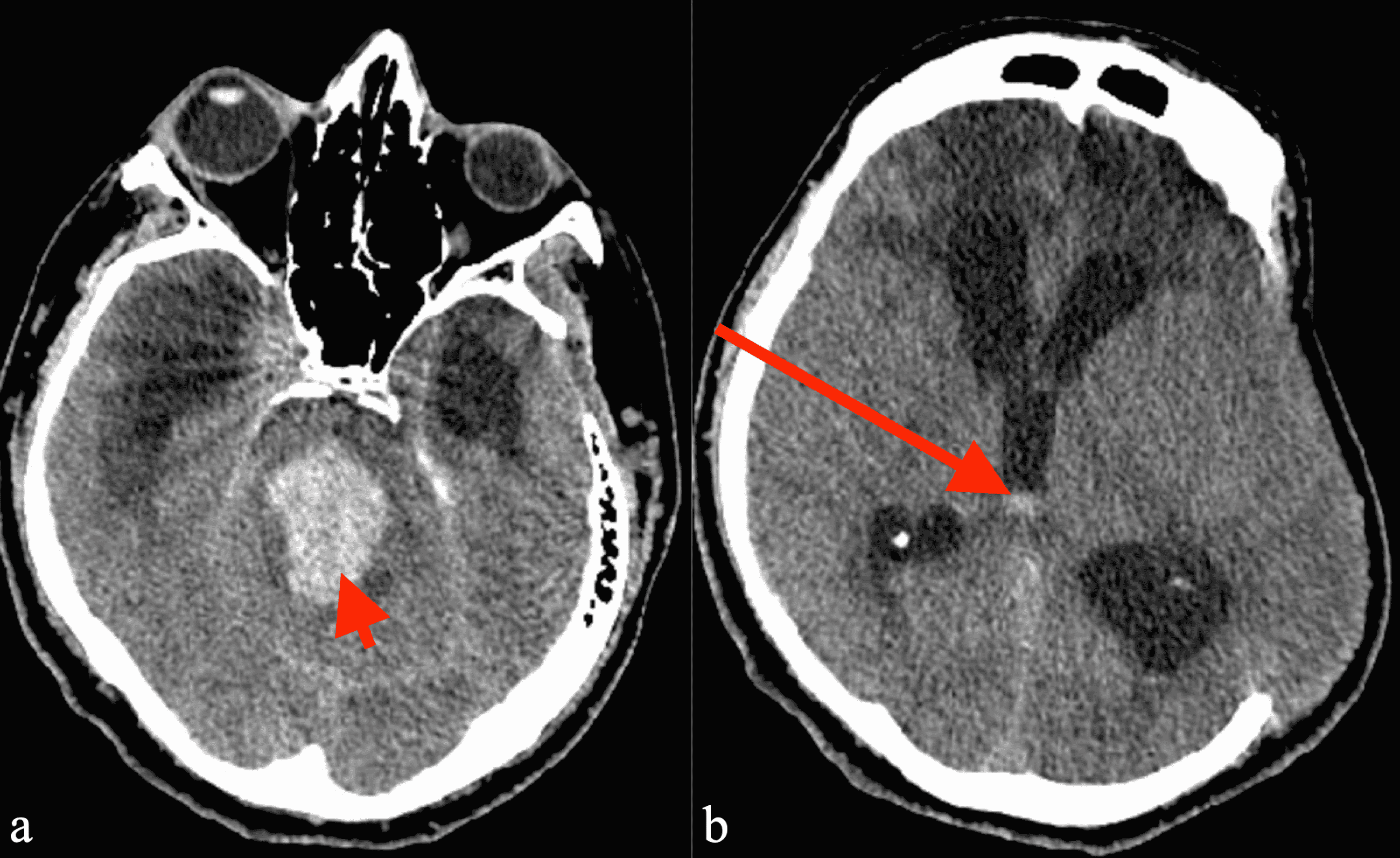 Brain hemorrhage epidural stroke hematoma subdural anatomy injury choose board skull medicine