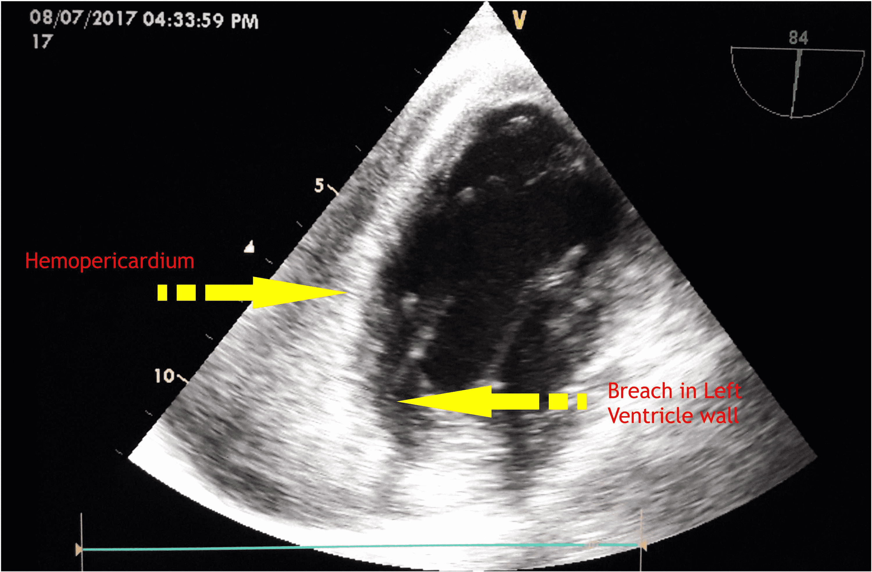 Cureus Perioperative Management of a Patient With Left Ventricular Free Wall Rupture After