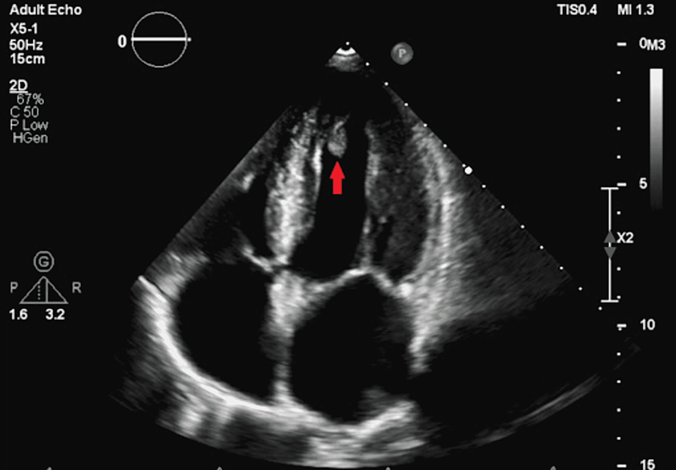 Isolated Left Ventricular Apical Hypoplasia