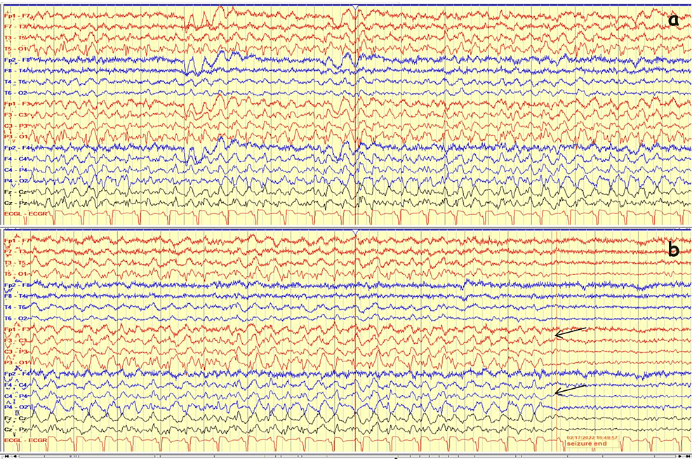 EEG-on-admission-day-(continued)