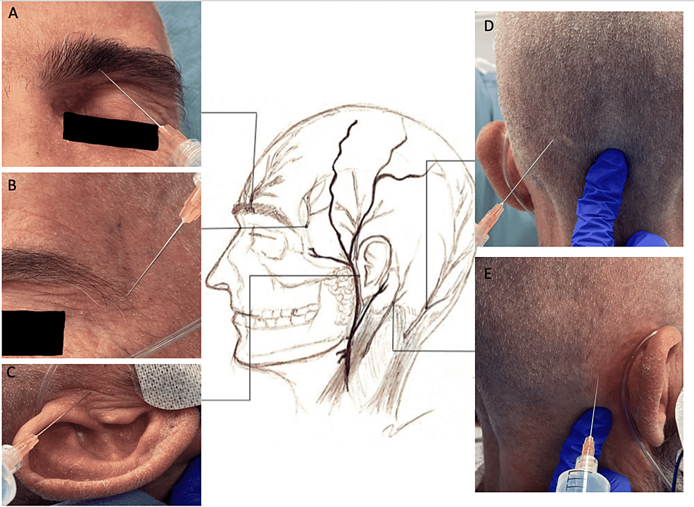 Regional-scalp-block-for-awake-craniotomy:-(a)-supraorbital-nerve,-(b)-zygomaticotemporal-nerve,-(c)-auriculotemporal-nerve,-(d)-greater-occipital-nerve,-and-(e)-lesser-occipital-nerve.