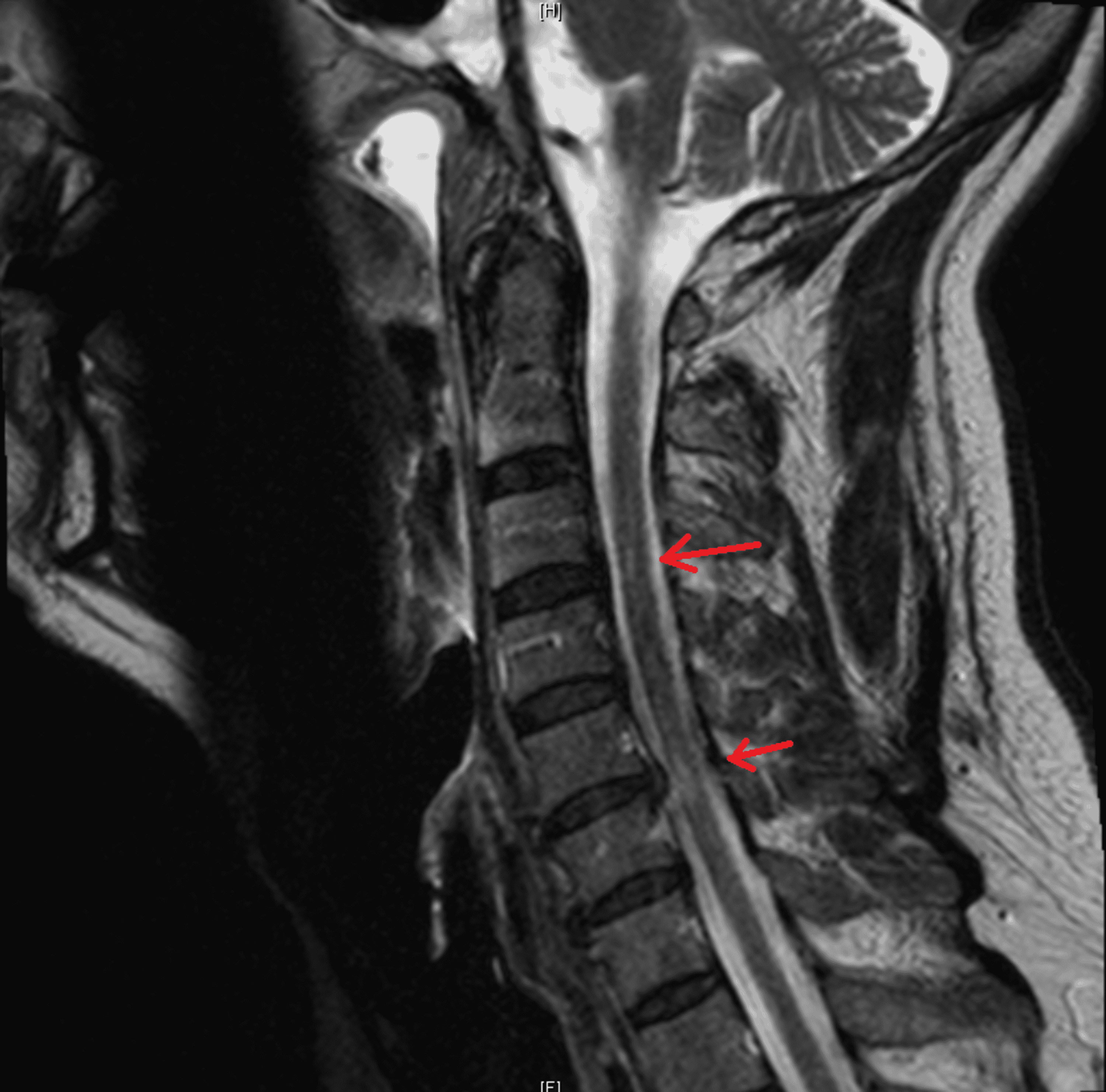 Cureus | Charles Bonnet Syndrome With Superimposed Delirium