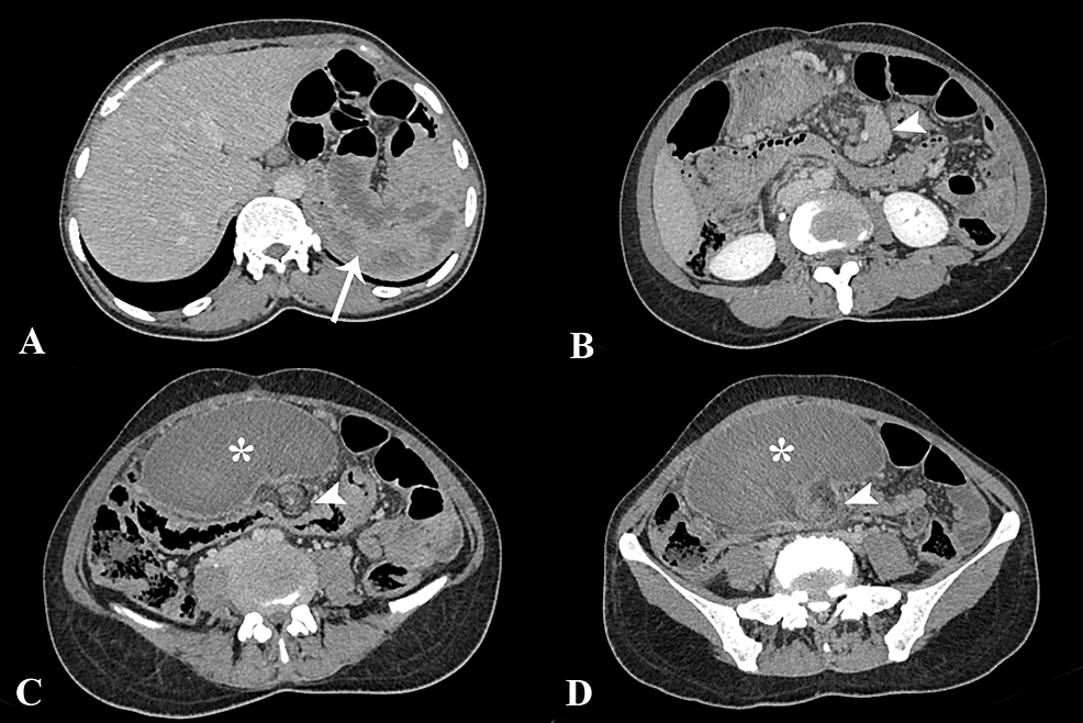 Cureus | Torsion of Wandering Spleen with Infarction