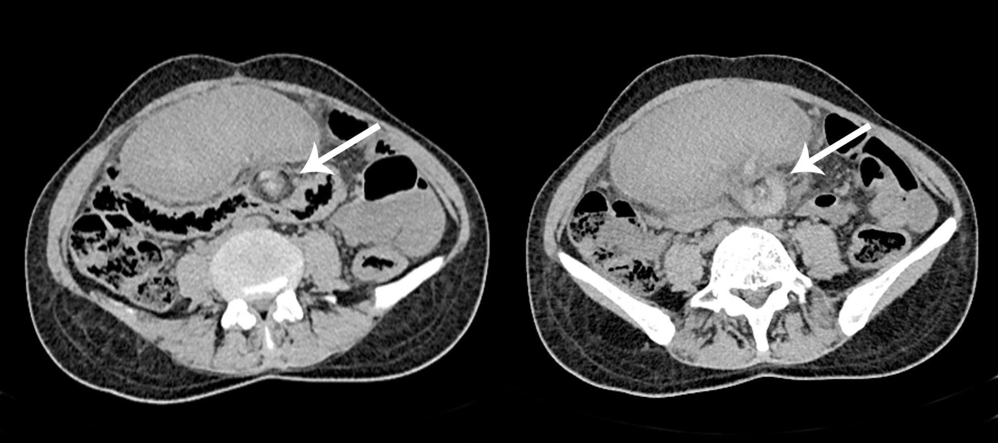 wandering spleen with torsion radiology