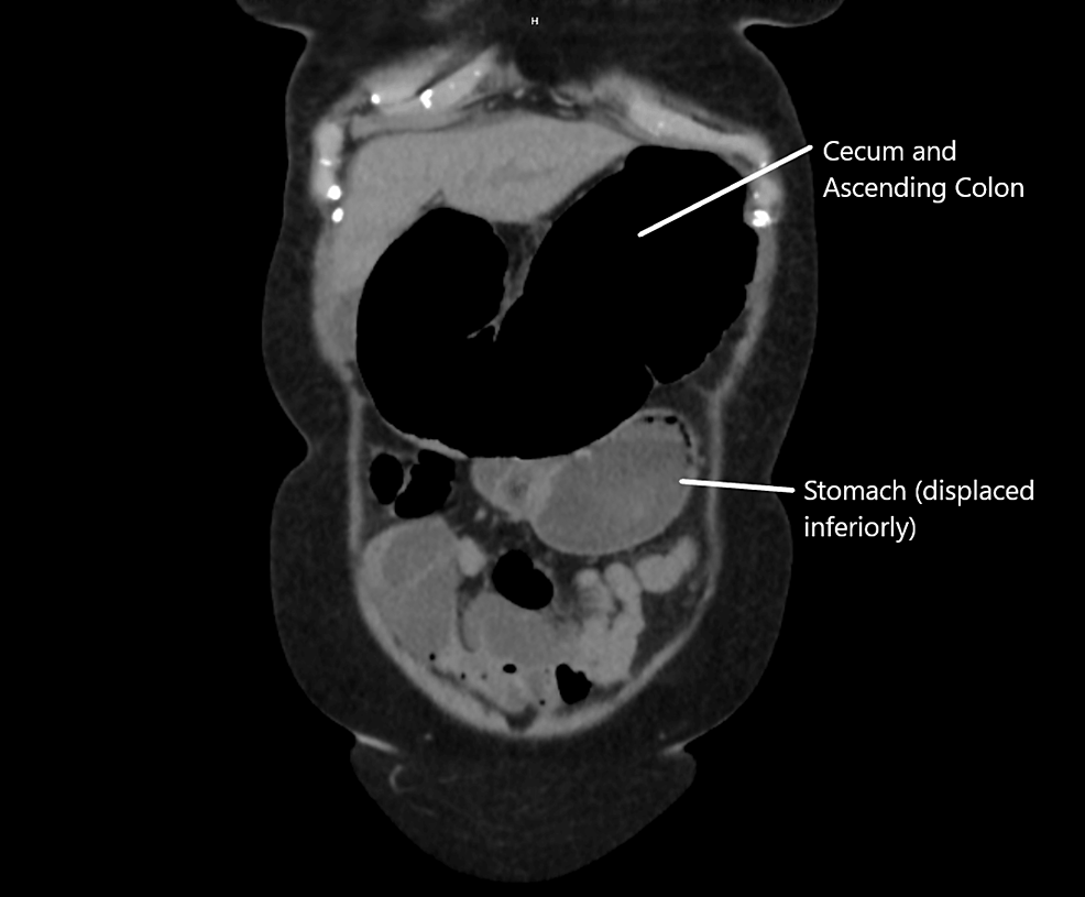 CT-abdomen-and-pelvis-without-contrast.-Distended-cecum-and-ascending-colon-shown-herniating-through-the-epiploic-foramen-of-Winslow-(not-shown).-The-cecum-and-ascending-colon-inferiorly-displaced-the-stomach.